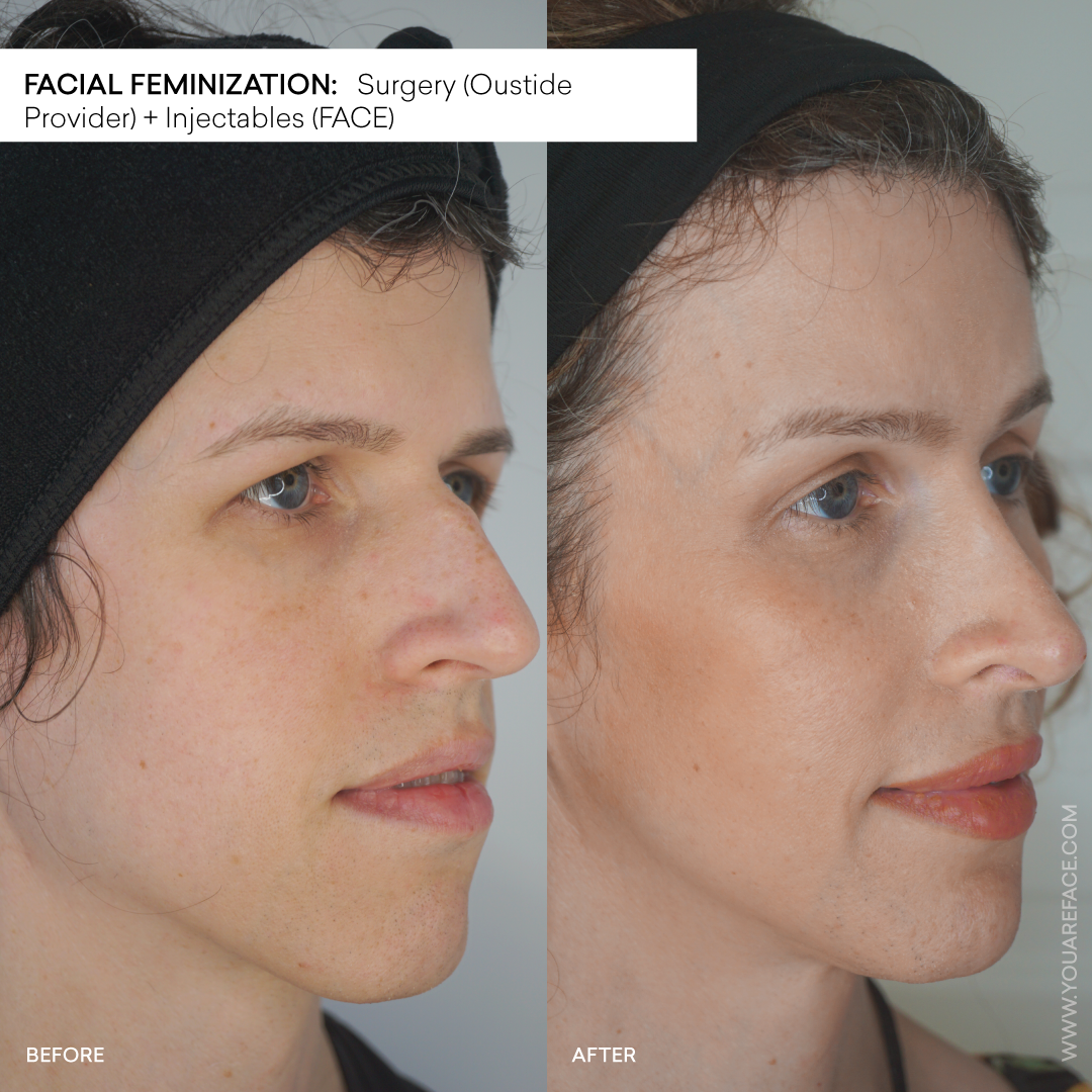 facial-feminization-injectables-before-after-oakland-face-medical.png