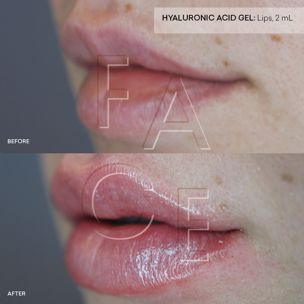 white-lumps-on-lips-after-juvederm-lipstutorial