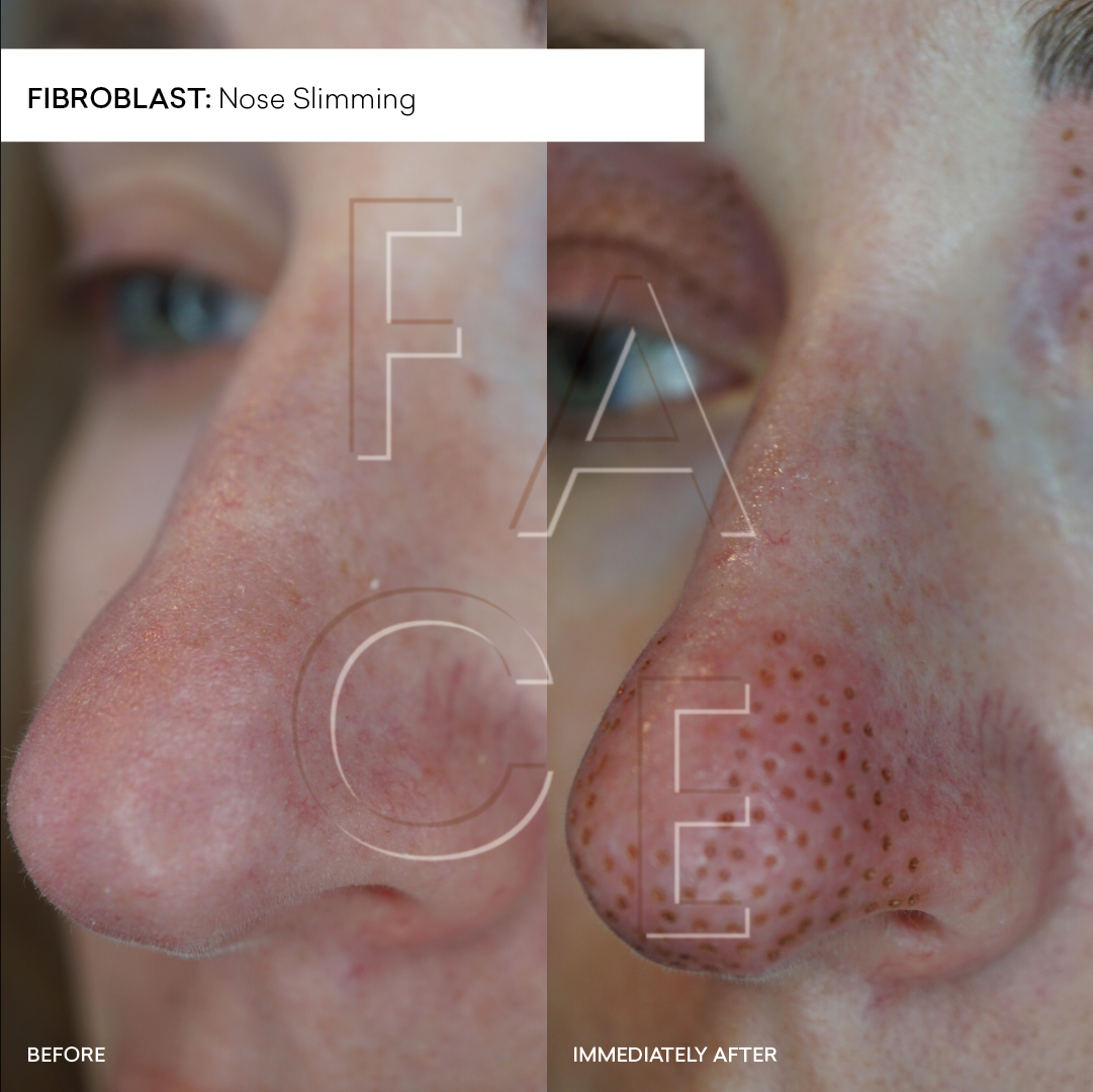 What Is a Fibroblast Nose Job & Does It Really Work? — FACE