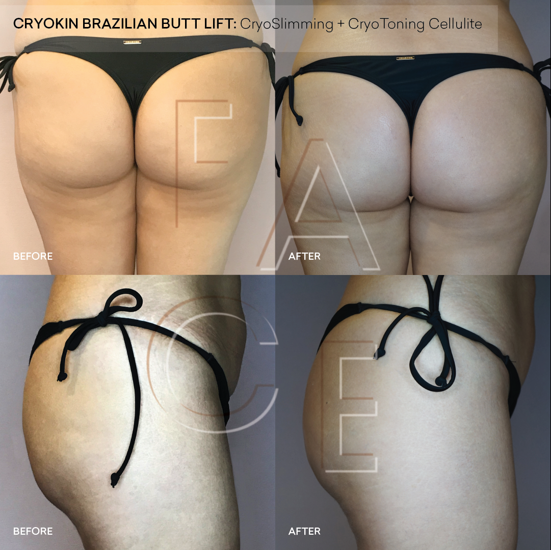 What exactly is a Brazilian butt lift?