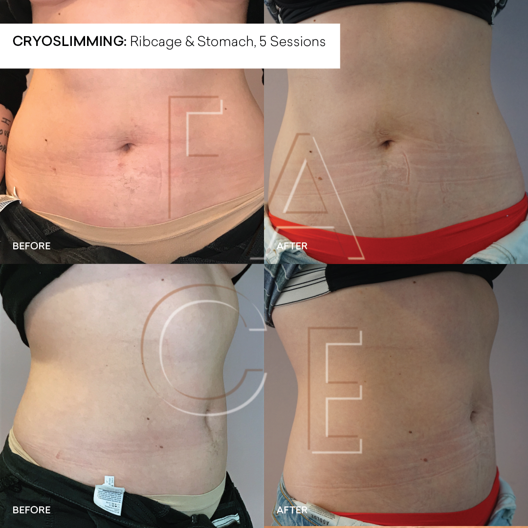 Cryo Slimming :: Non-Invasive Body Contouring Fat Reduction