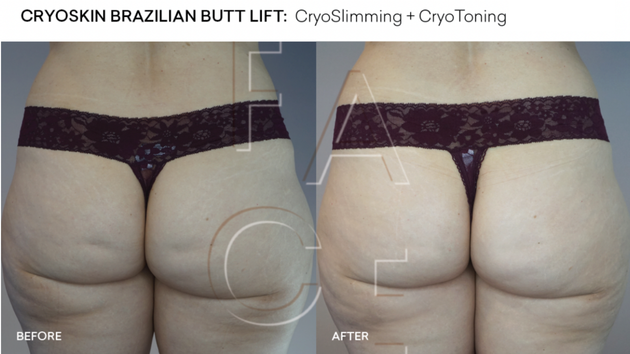 Non-Surgical Butt Lift vs Brazilian Butt Lift: What is the difference? -  The Cosmetic Skin Clinic
