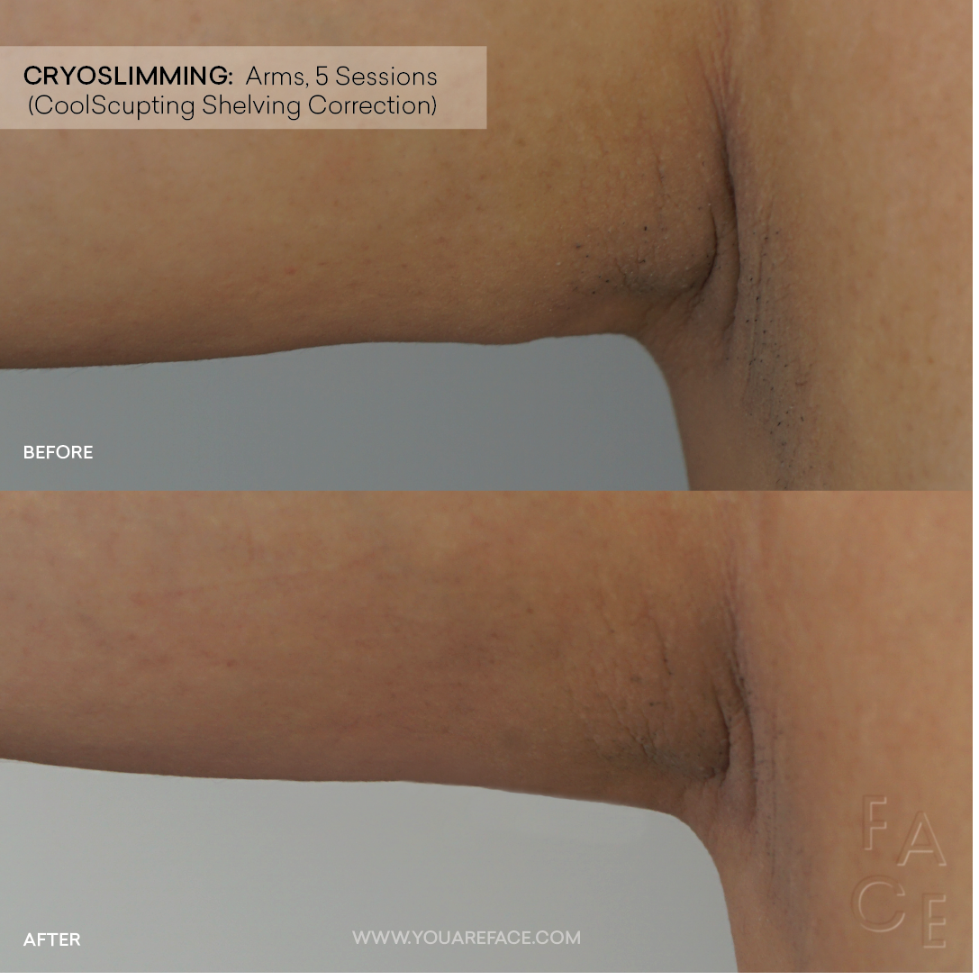 Cryoskin vs. CoolSculpting: What You Need to Know — FACE