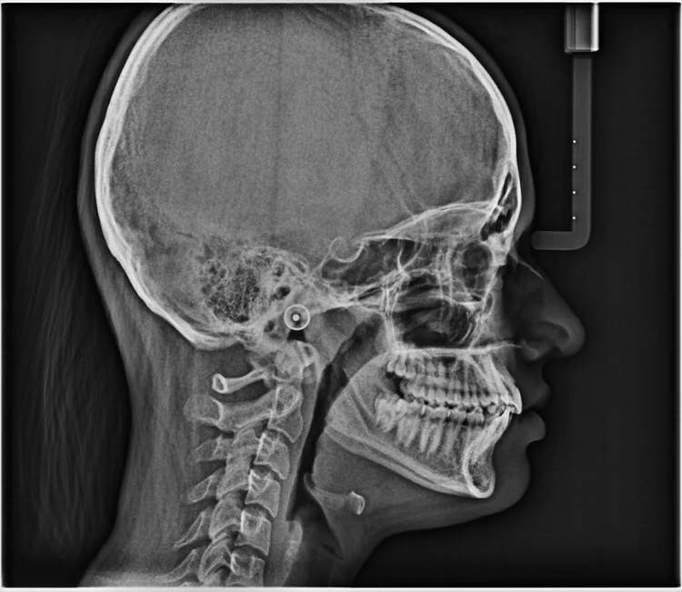 Cephalogram with Tracing and Analysis at DMD Imaging