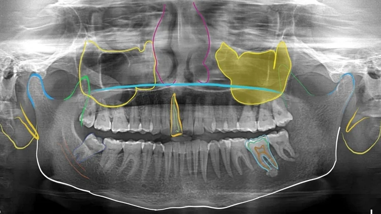 Digital OPG at DMD Imaging