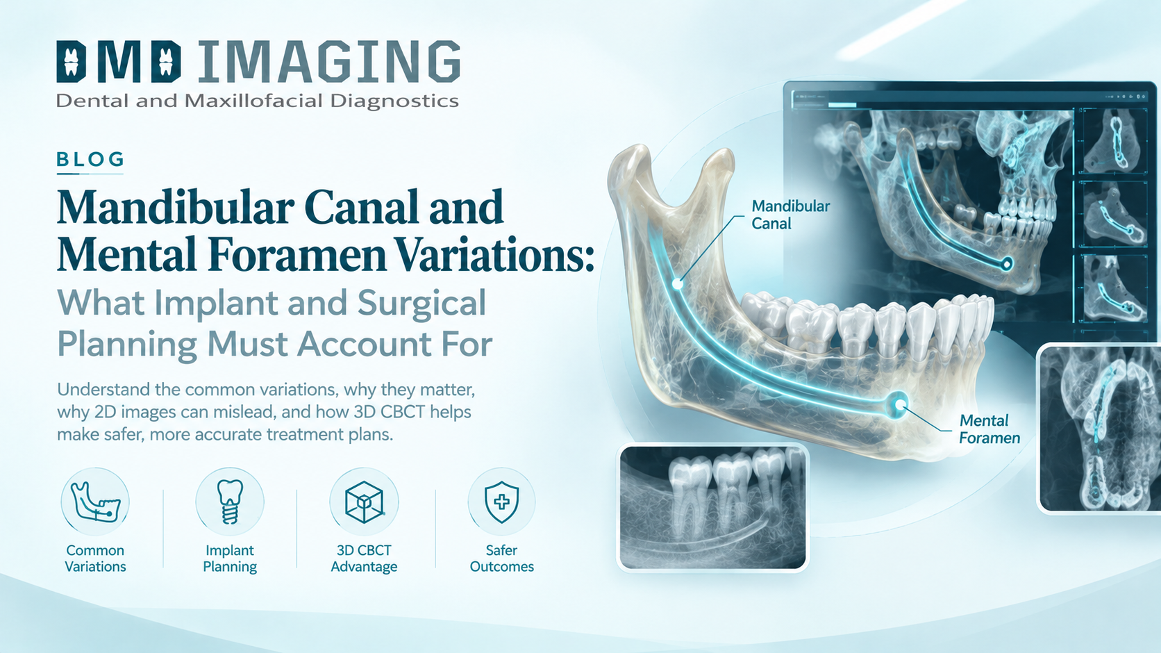 Mandibular Canal and Mental Foramen Variations: What Implant and Surgical Planning Must Account For