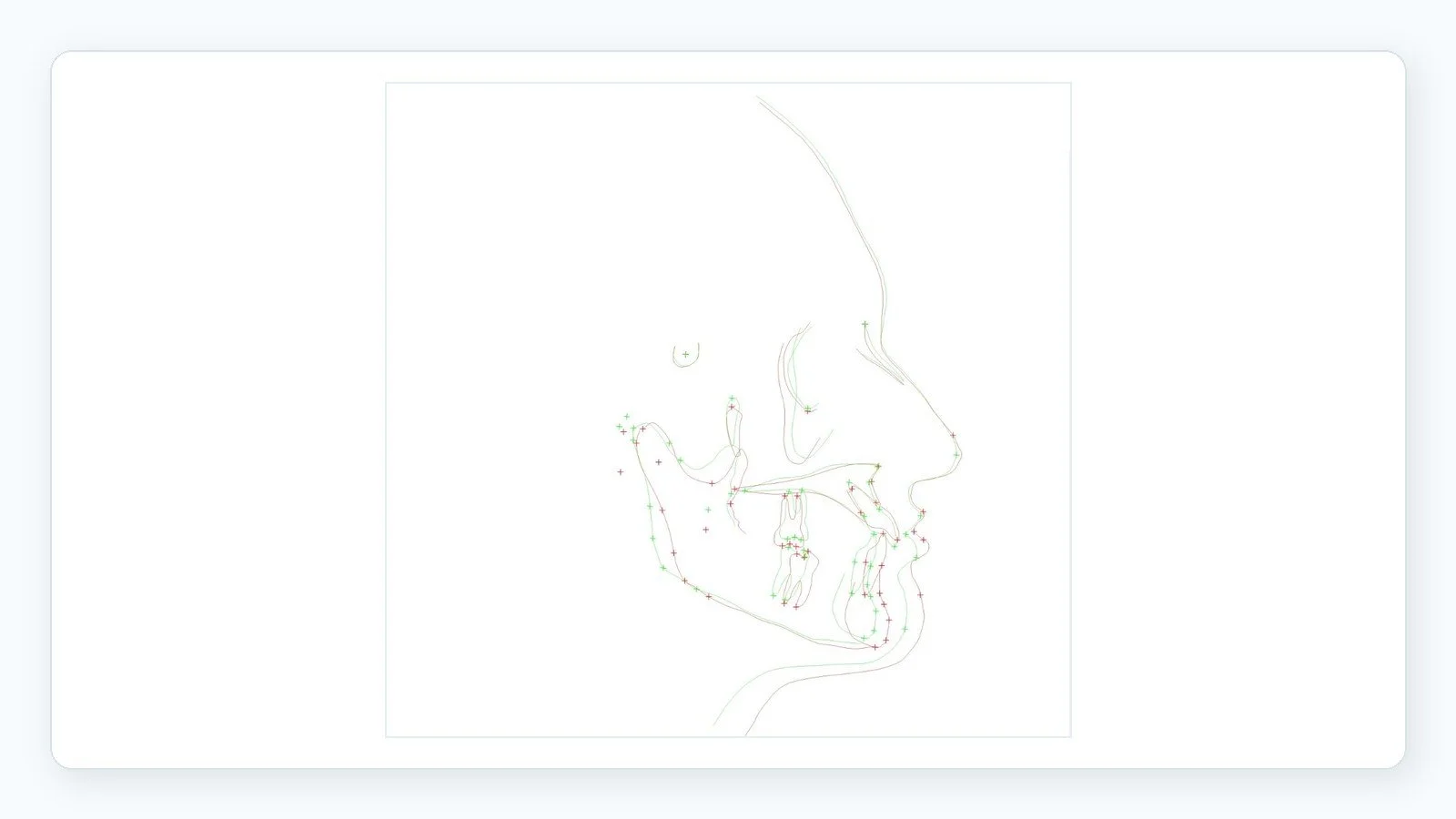Cephalometric superimposition tracing showing jaw and facial profile changes for surgical orthodontic treatment planning.