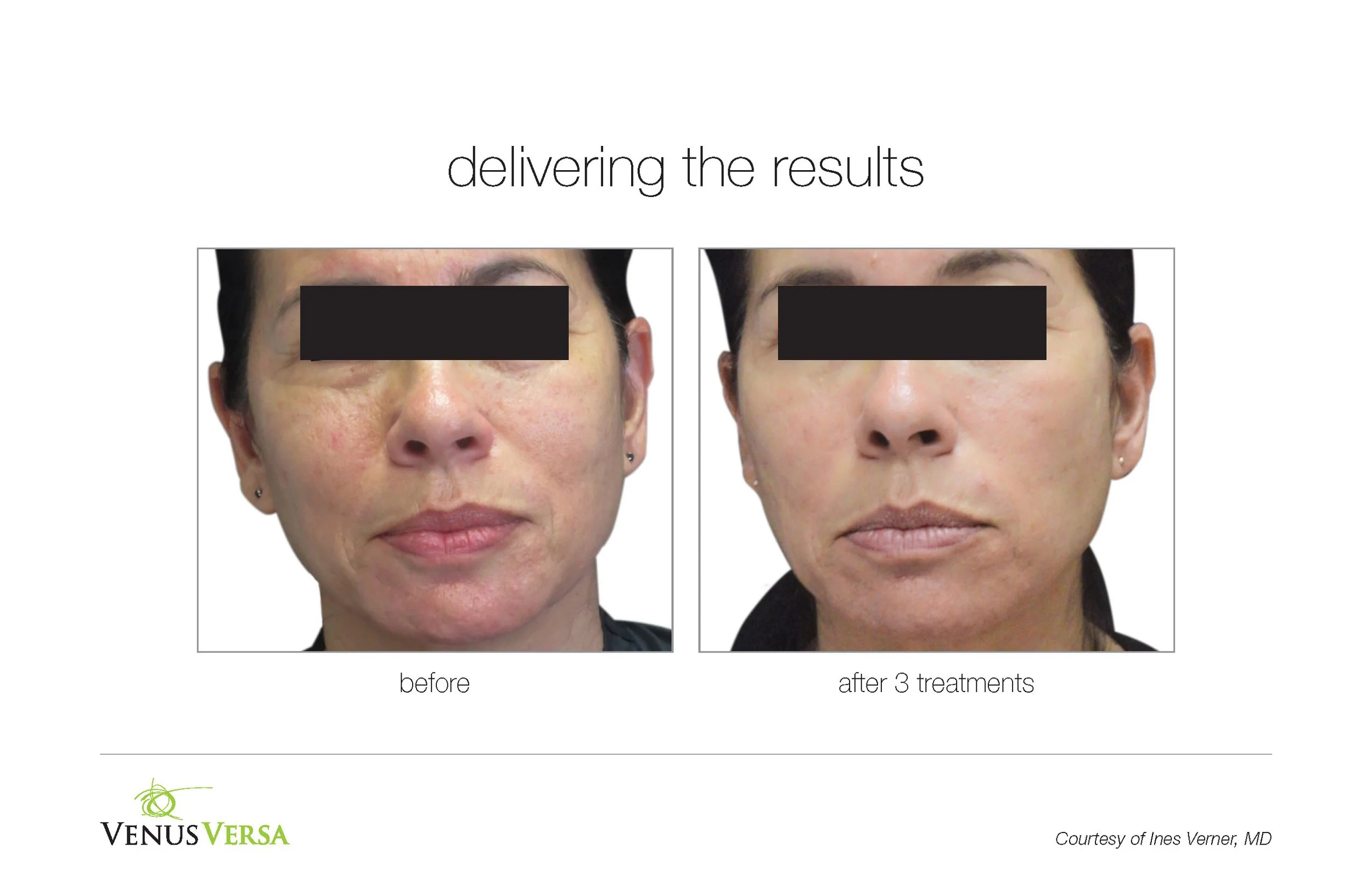Before and after photos of a woman showing improved skin condition after three treatments, with the company's logo and a note of courtesy to Dr. Ines Verner.