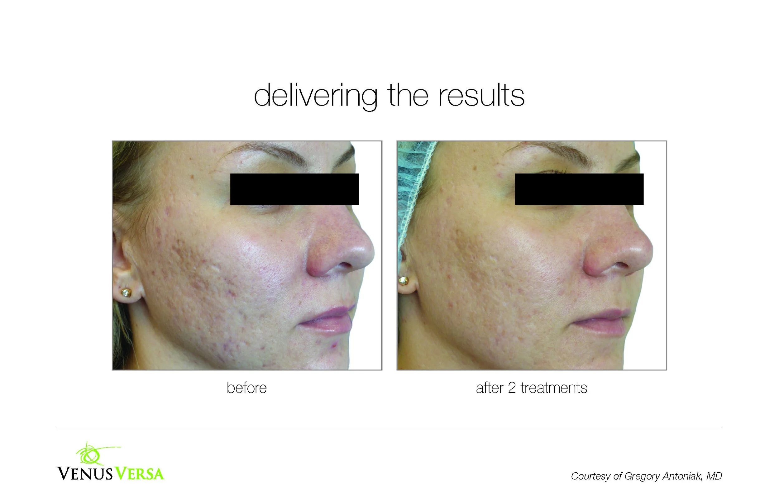 Side-by-side comparison of a woman’s face before and after two acne treatments, showing reduced acne scars and improved skin texture.