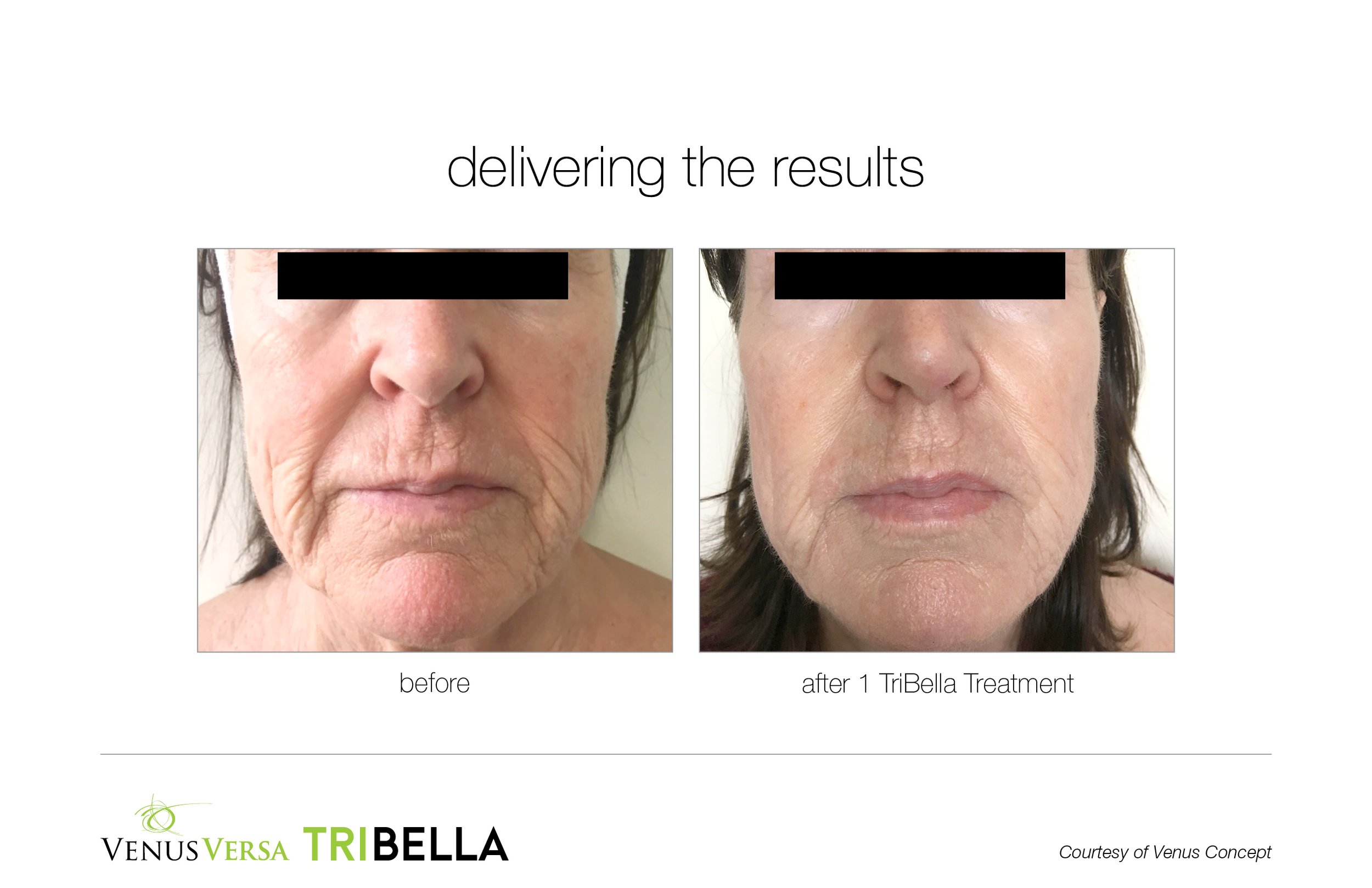 Before and after images showing skin improvement on a woman's face following one TriBella treatment, with the text 'delivering the results' above the photos