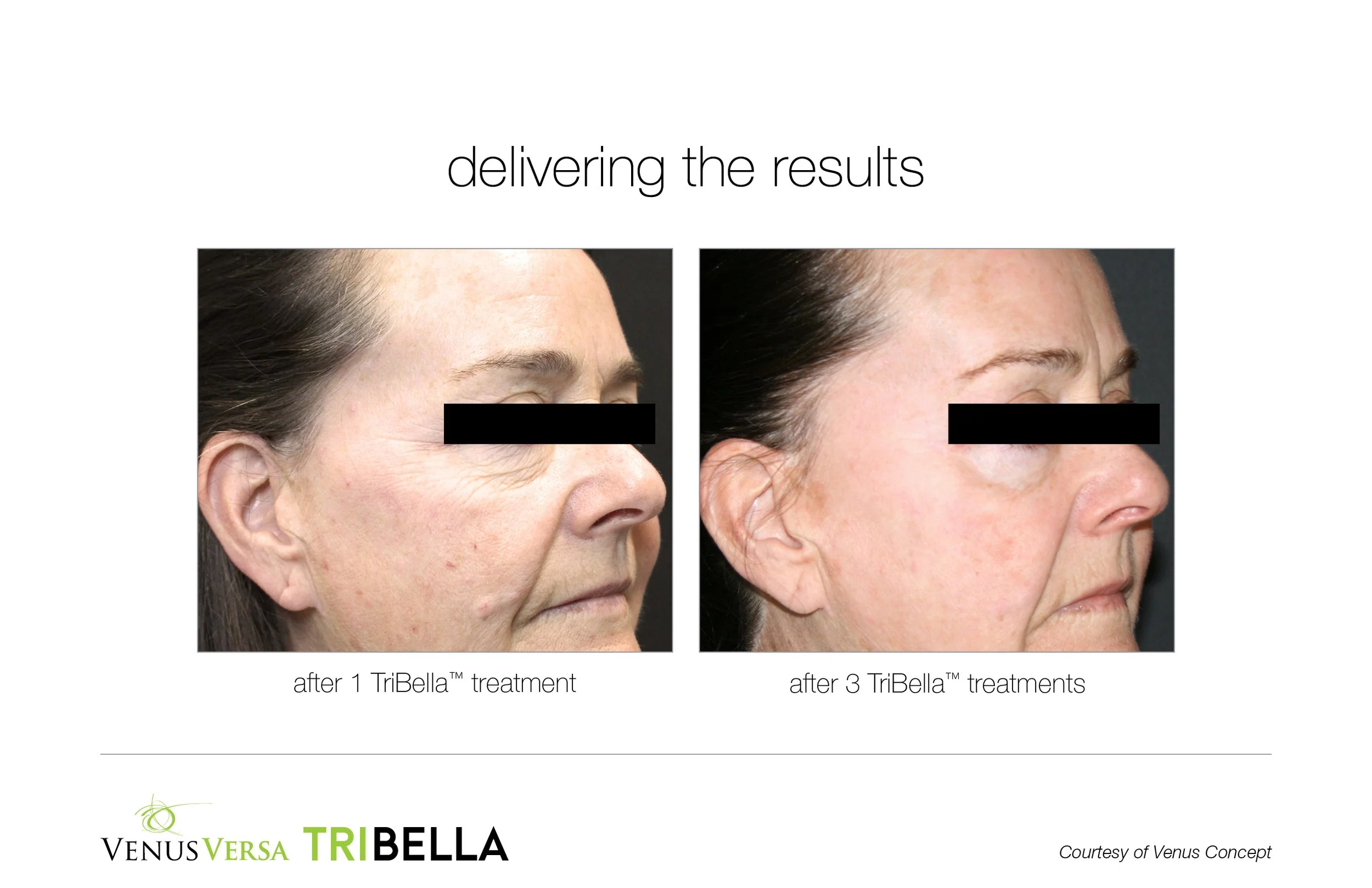 Side-by-side comparison of a woman's face before and after TriBella treatment showing reduction in wrinkles and skin improvement