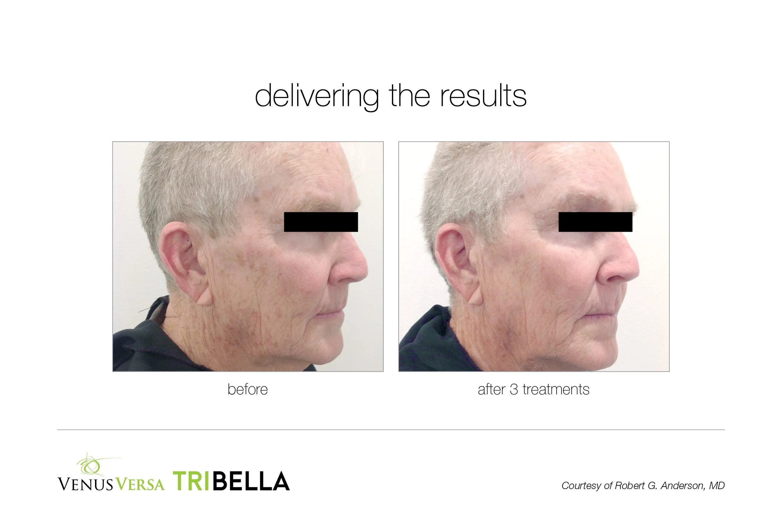 Side-by-side comparison of a woman's face before and after three treatments showing reduced wrinkles and age spots.