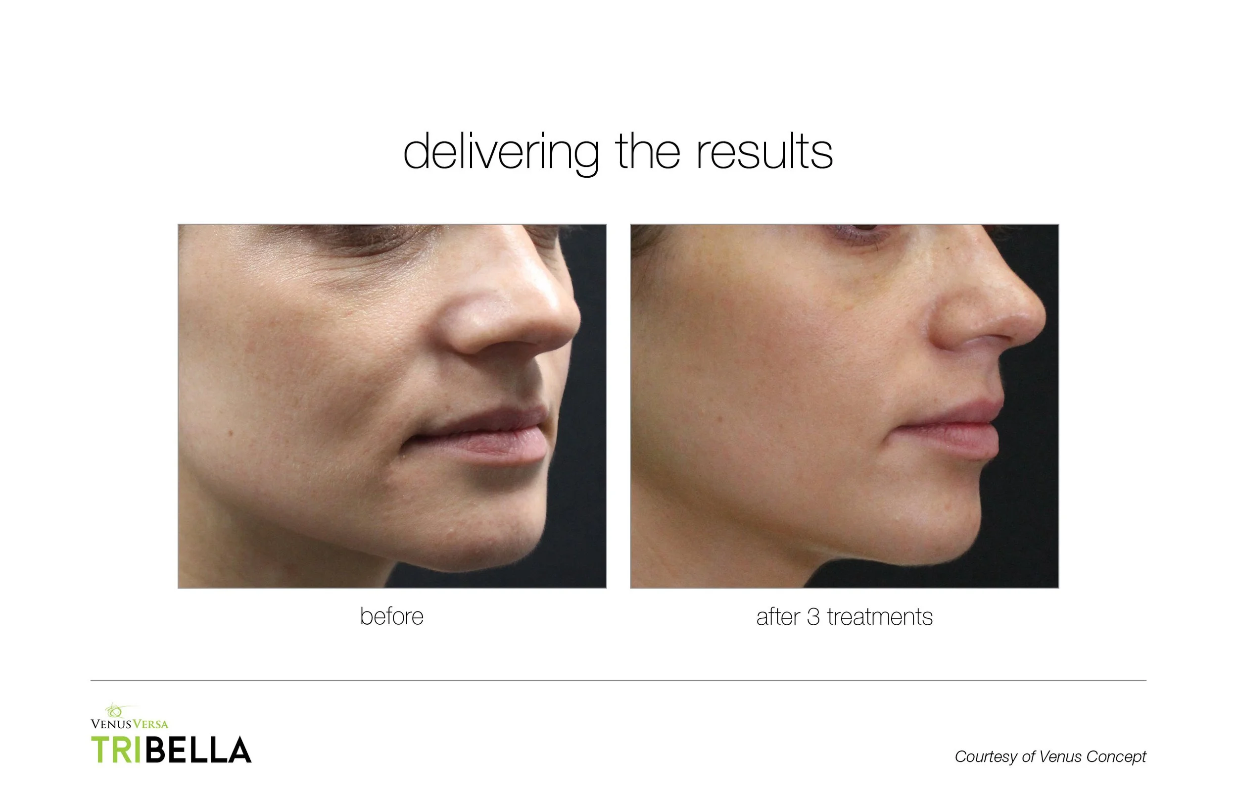 Side-by-side comparison photo of a woman's face showing the skin before and after three treatments with visible improvement in skin texture and appearance. The left image is labeled "before" and the right image is labeled "after 3 treatments."