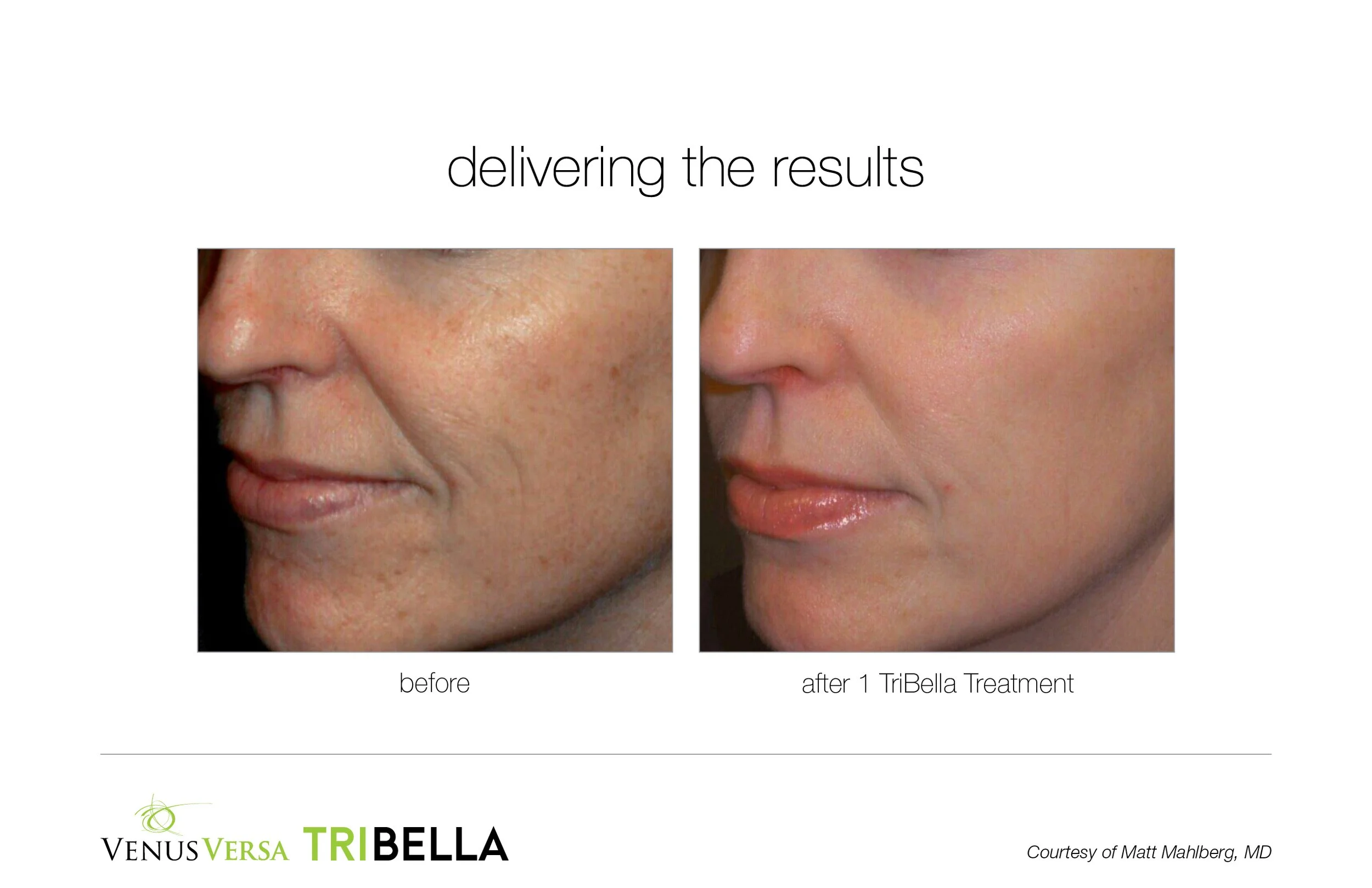 Side-by-side comparison of a woman's face before and after one TriBella treatment, showing improvement in skin texture and appearance.