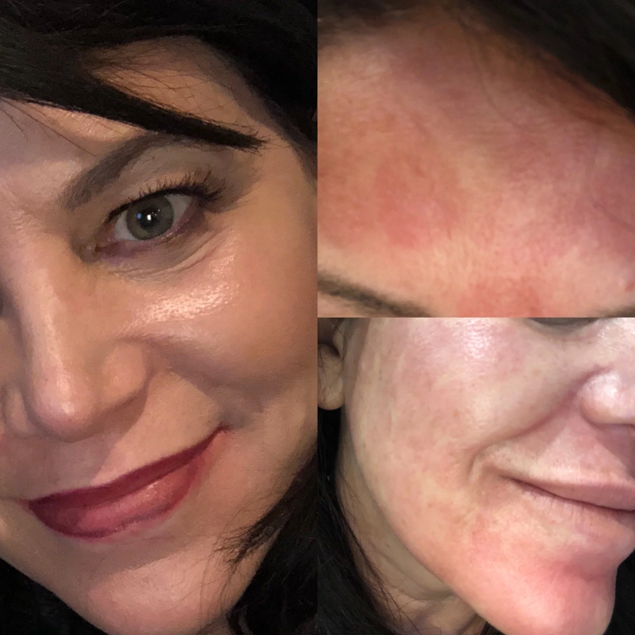 RESURFX LASER, RECOVERY AND AFTER