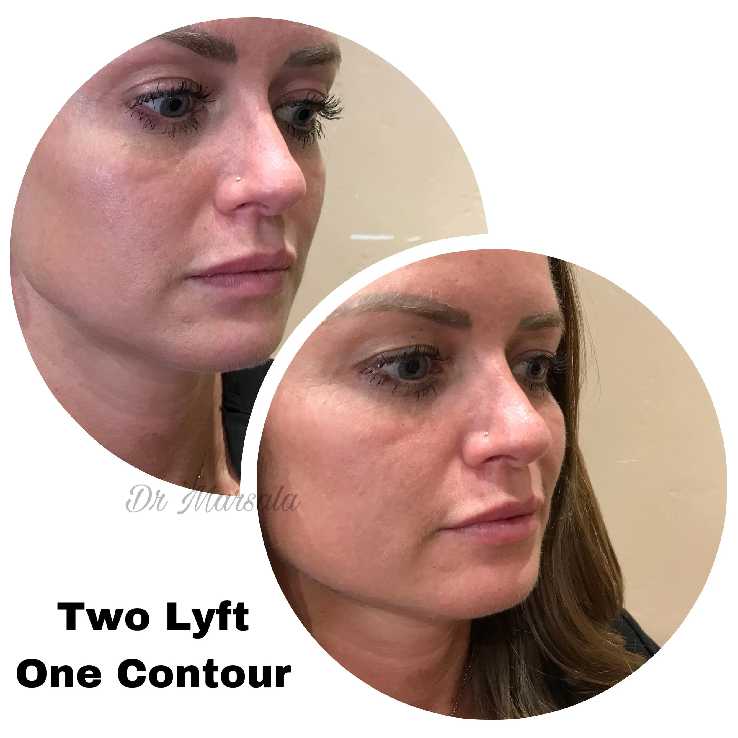 INJECTABLES, cheeks and sculptra
