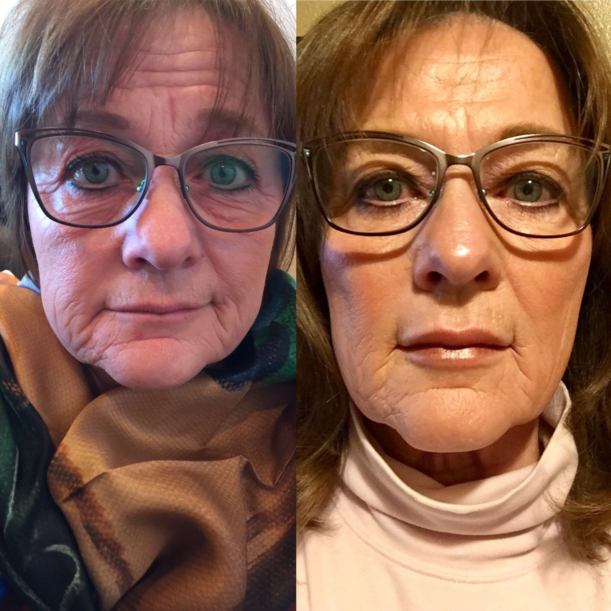 PEELS, FILLERS, SKIN CARE