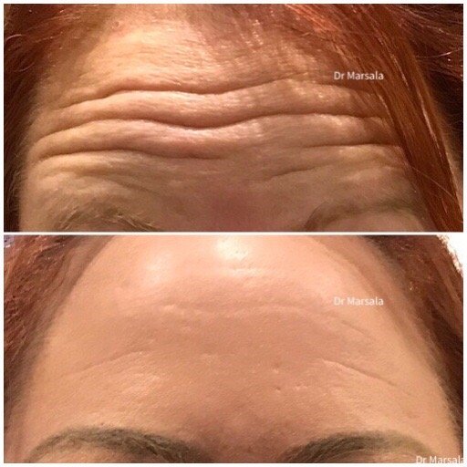 Botox/Dysport/Xeomin! Just get it done for prevention and reversal of those annoying wrinkles.