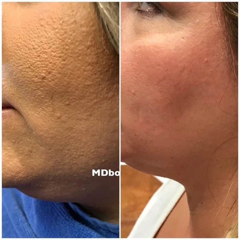 All it takes sometimes is a professionally prescribed ZO skin care regimen to change you skin texture!