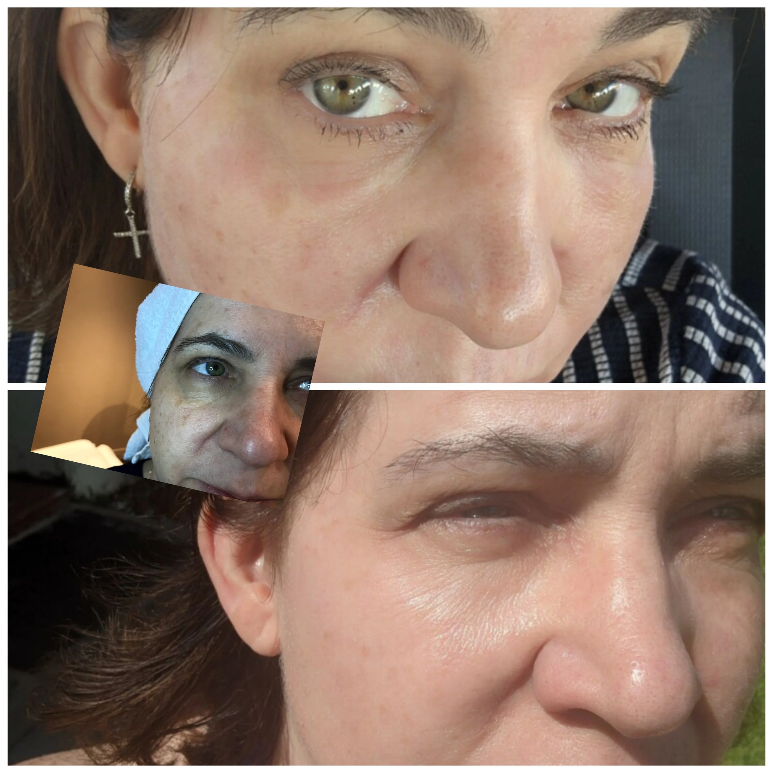 Triple threat laser treatment! 