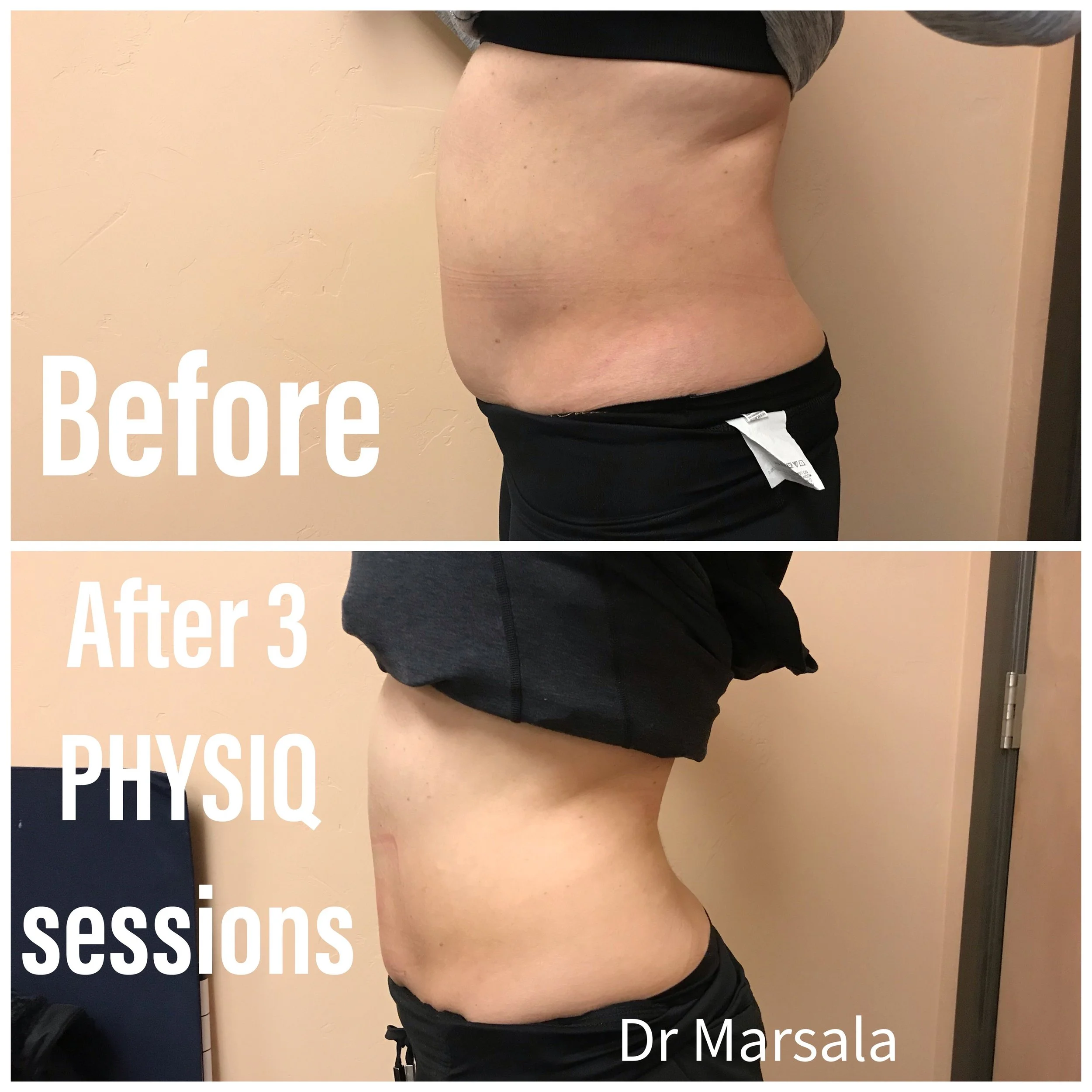 This is an amazing result of body sculpting with PHYSIQ!