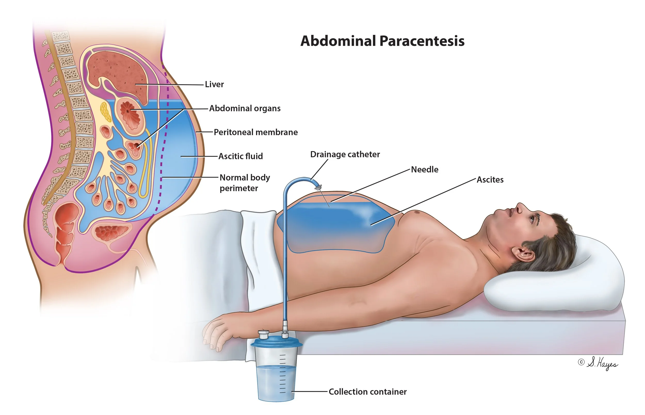 Abdominal Paracentesis