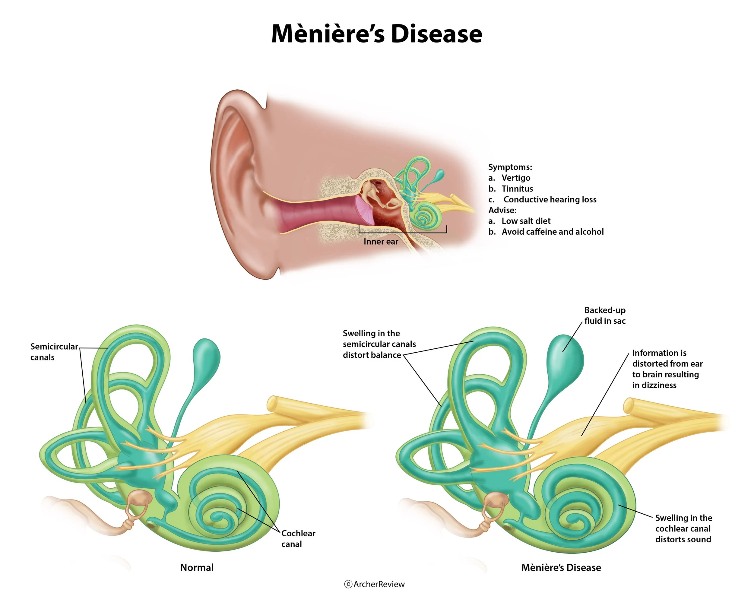Meniere's Disease
