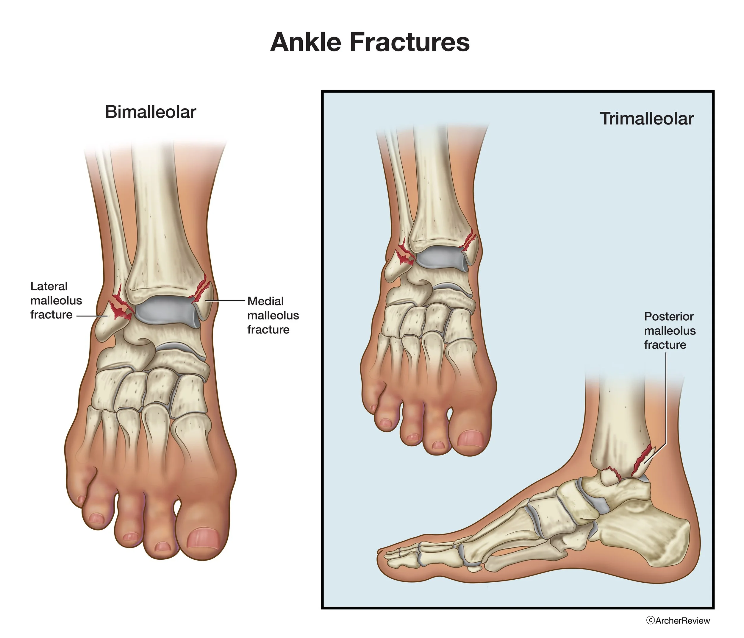 Ankle_Fractures.jpg
