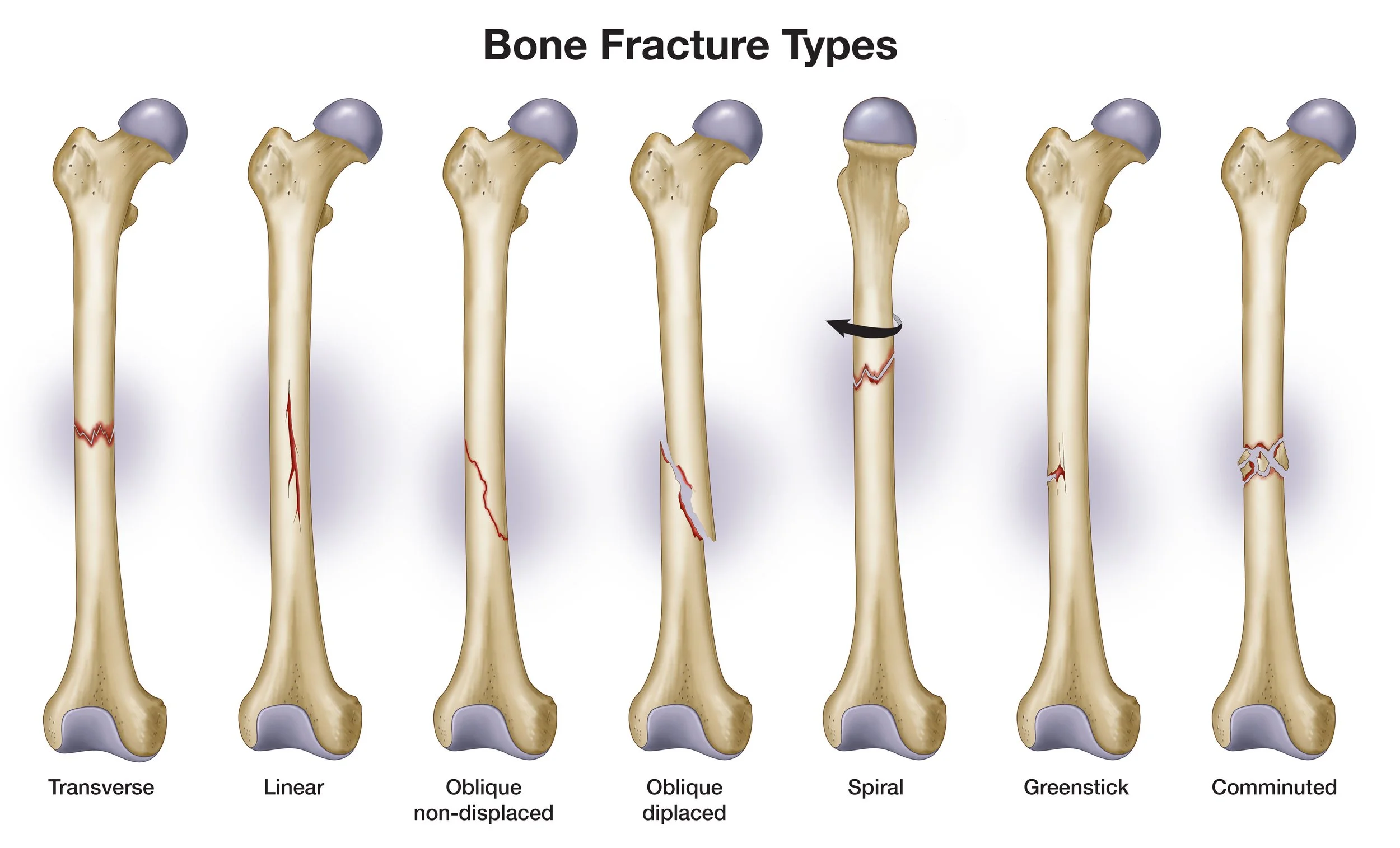 Bone Fracture Types