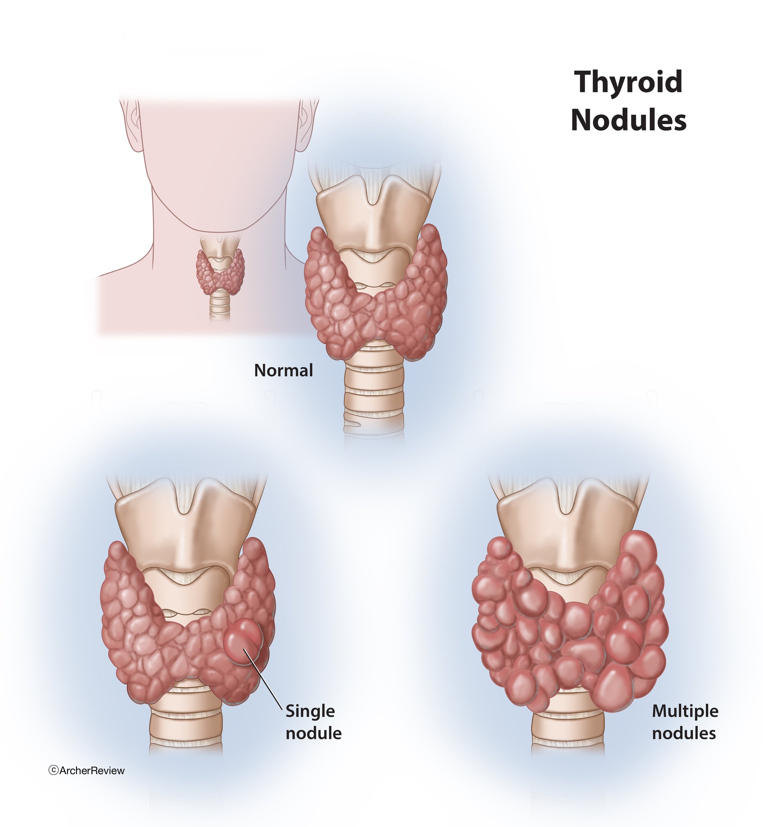 Thyroid_Nodules.jpg