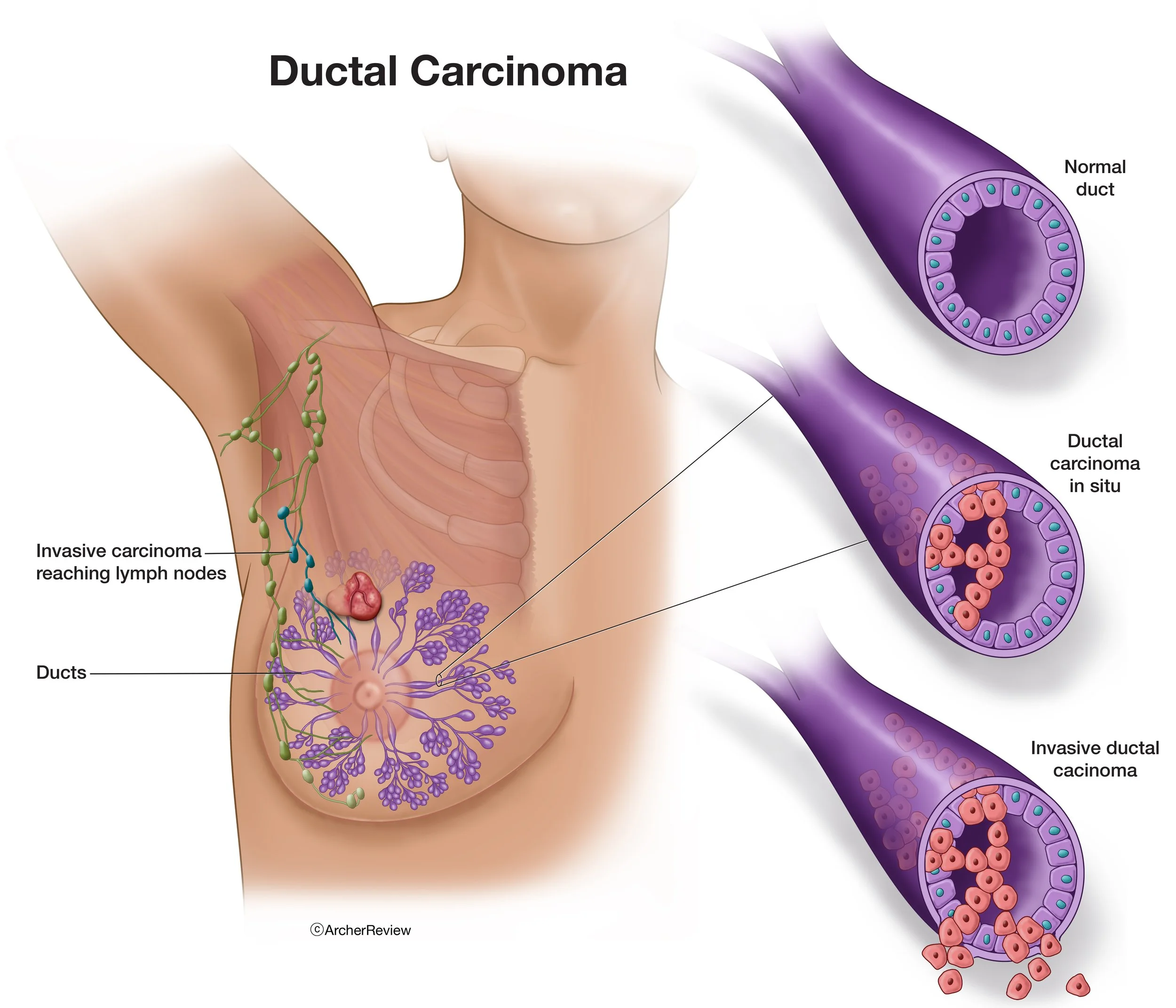 Ductal_Carcinoma.jpg
