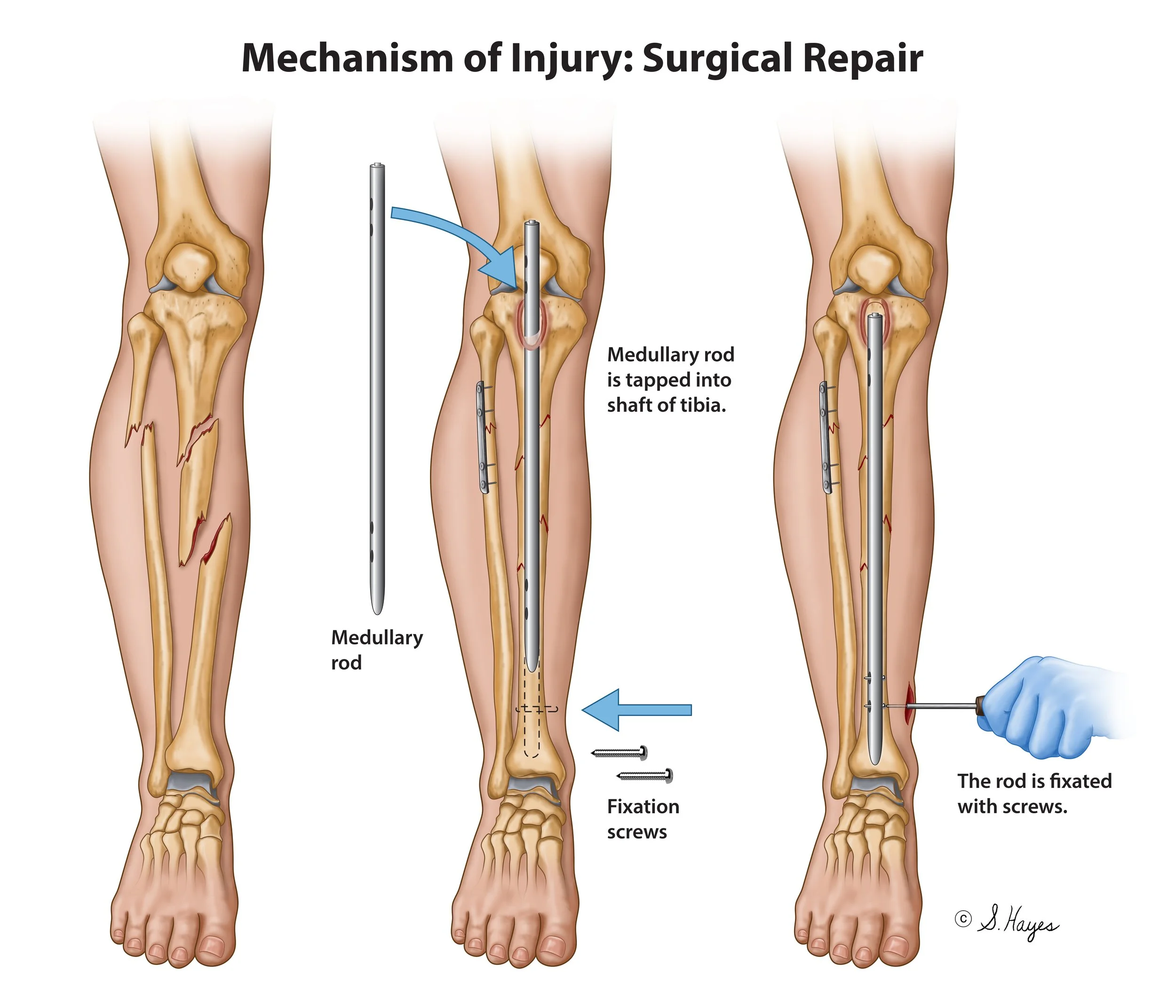 Mechanism of Injury: Surgical Repair