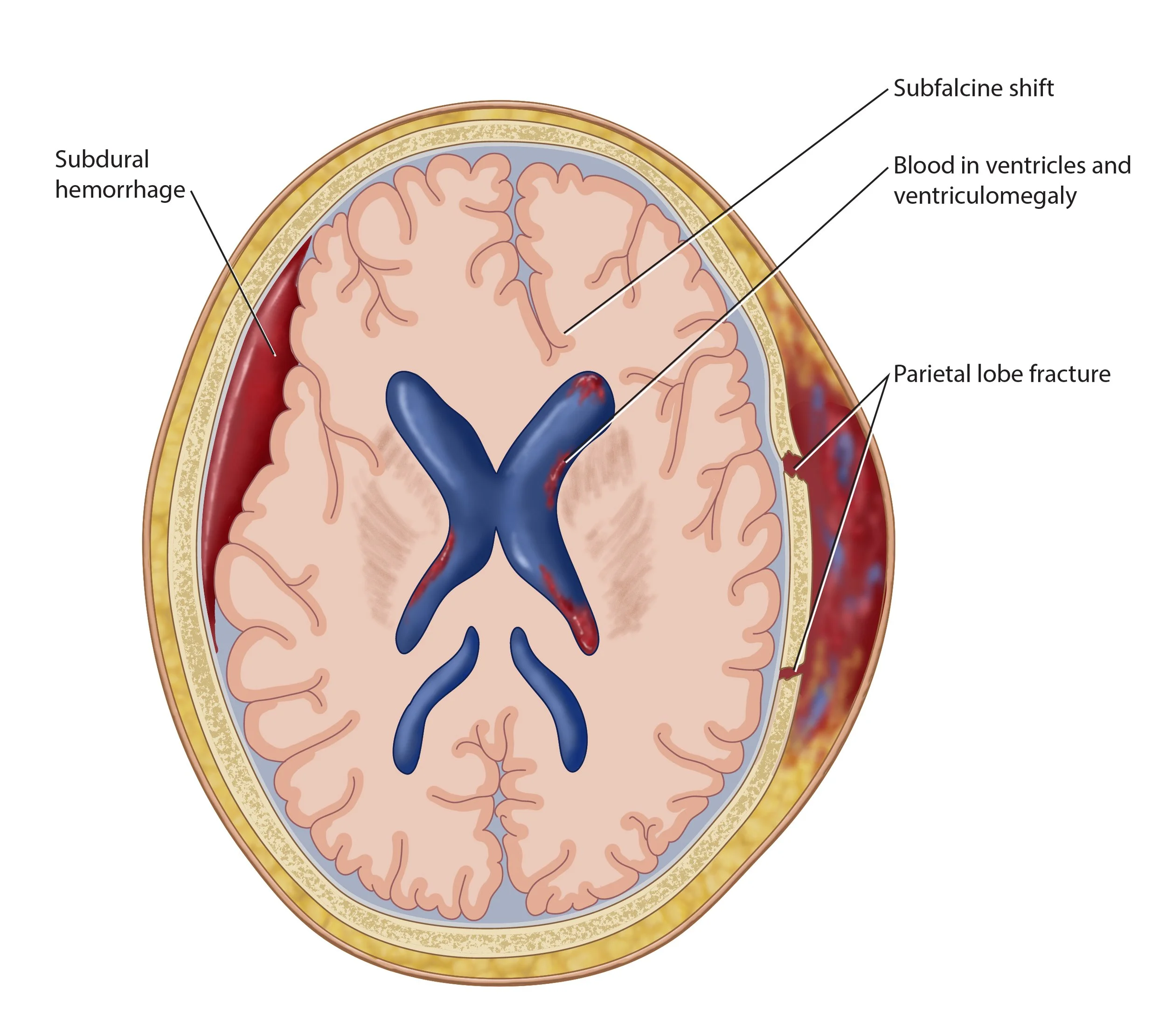 Subdural Hematoma