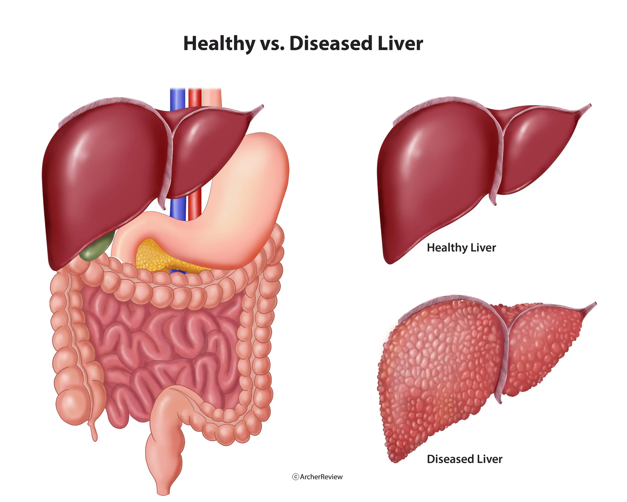 Healthy vs Diseased Liver