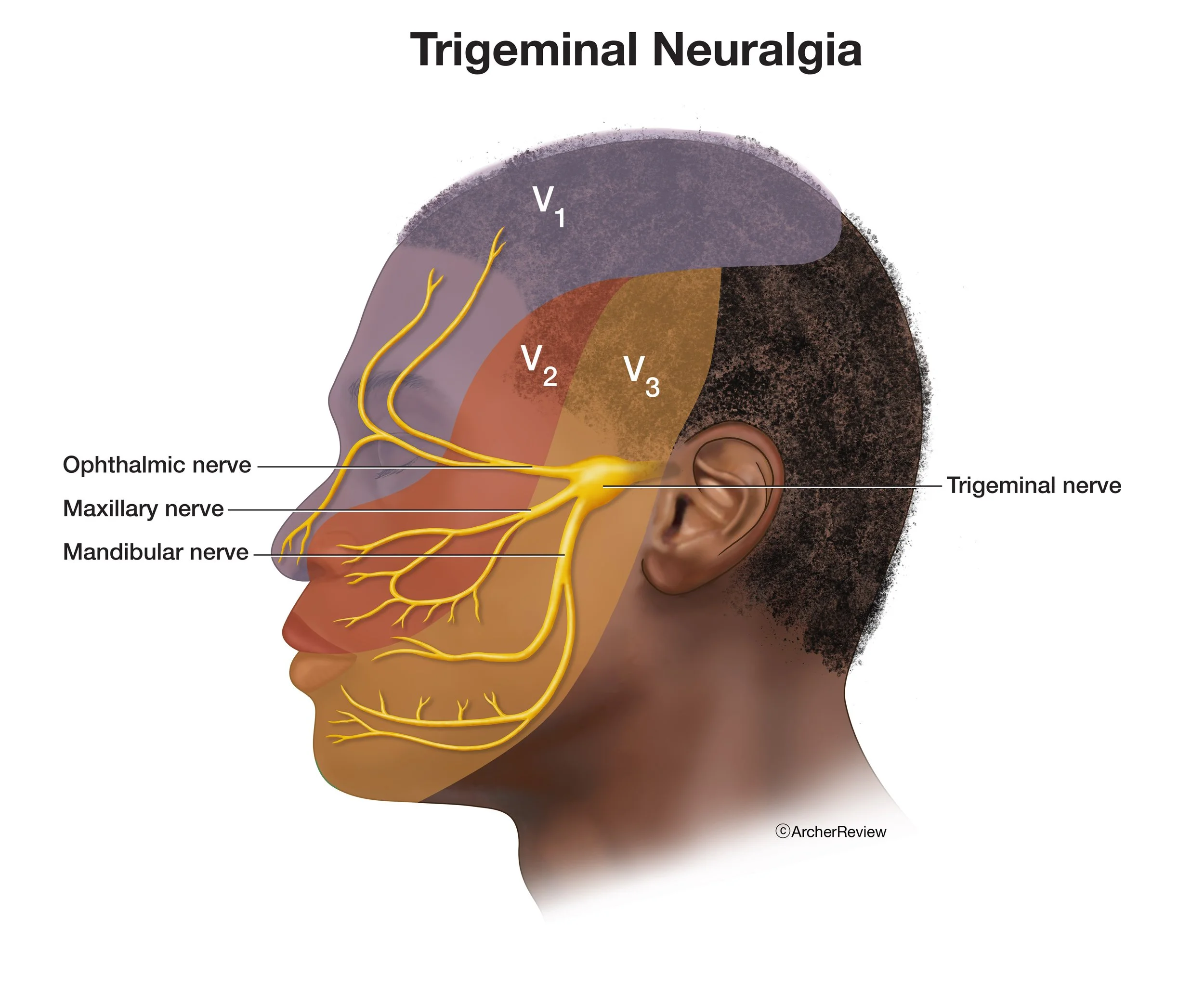 Trigeminal Neuralgia