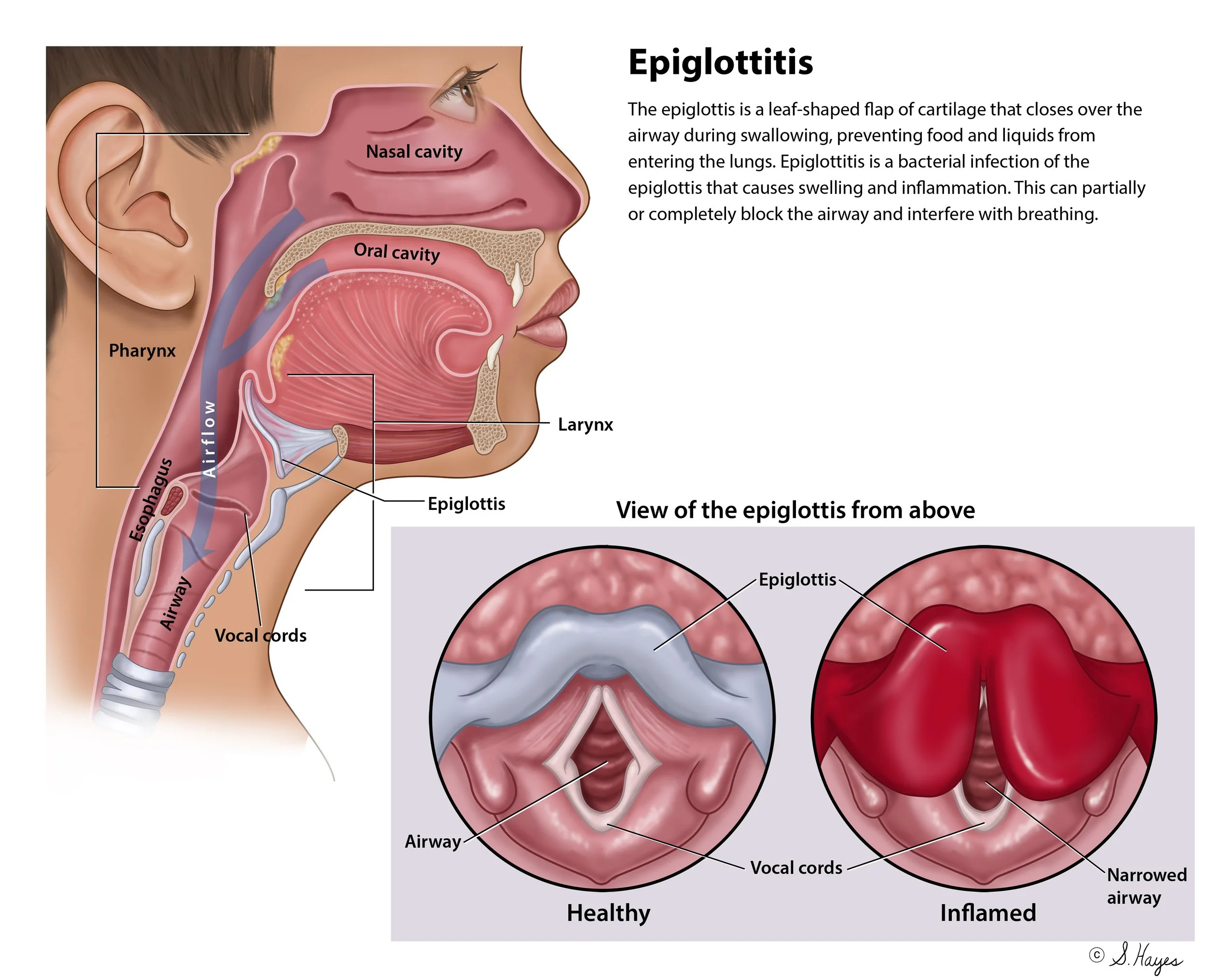 Epiglottitis