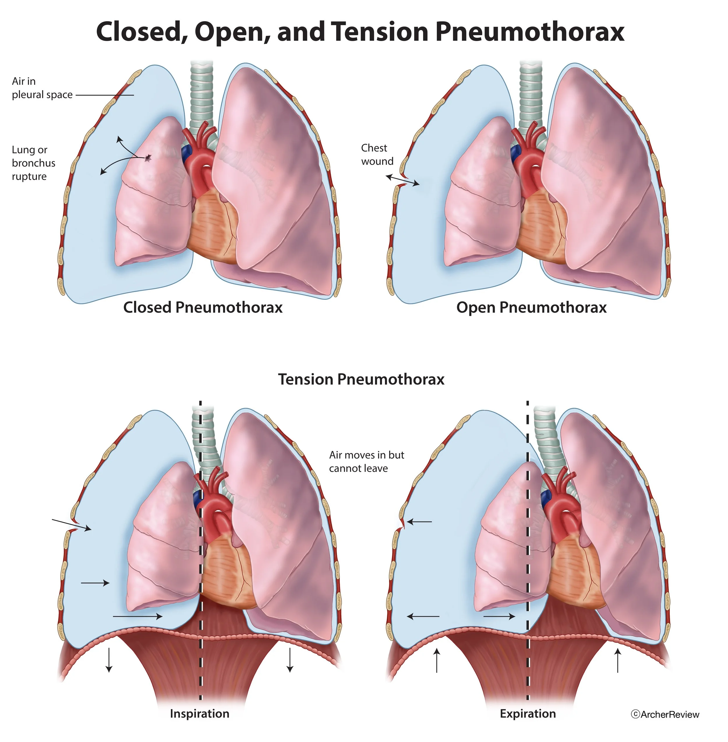 Closed_Open_Tension_Pneumothorax.jpg