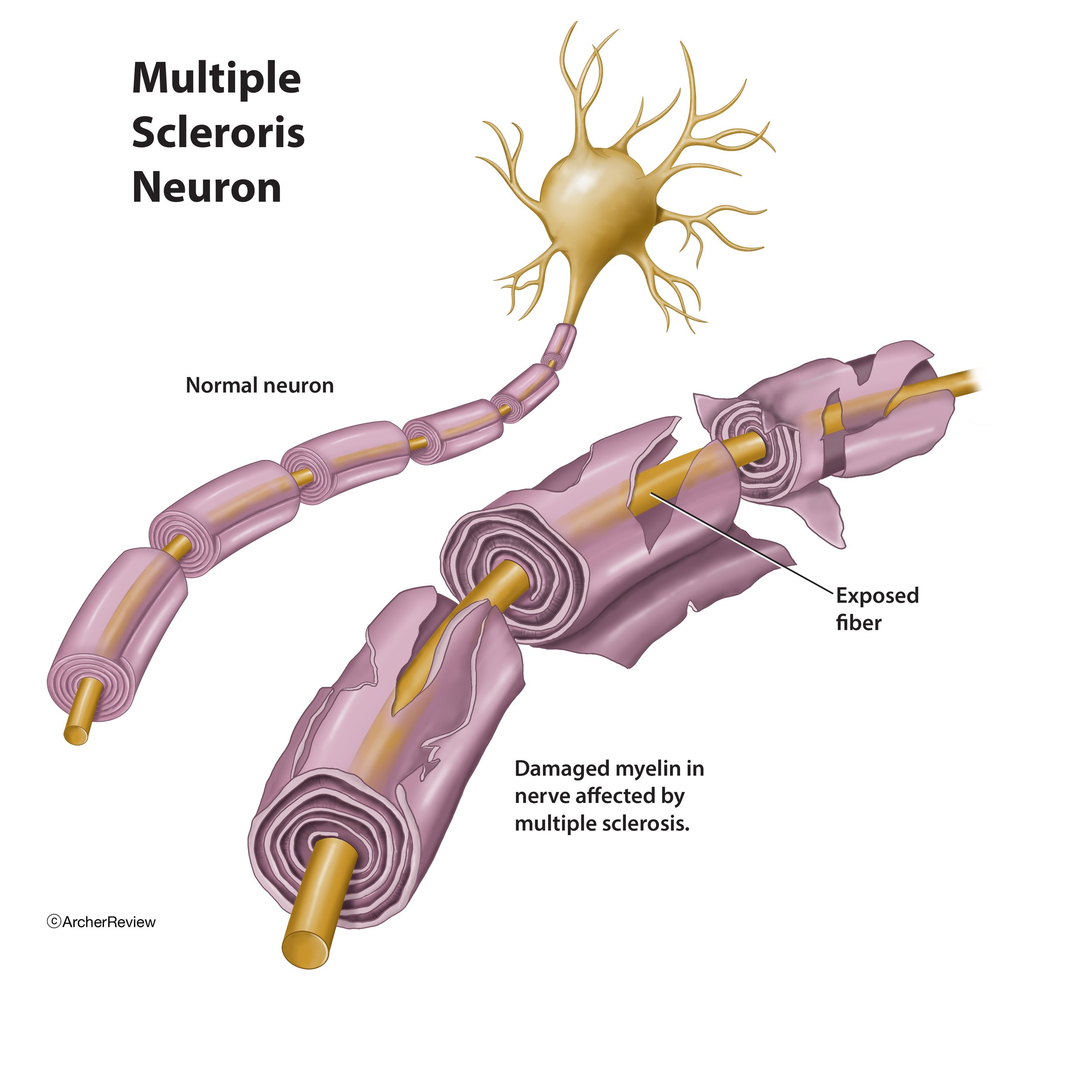 Multiple_Sclerosis_Neuron.jpg