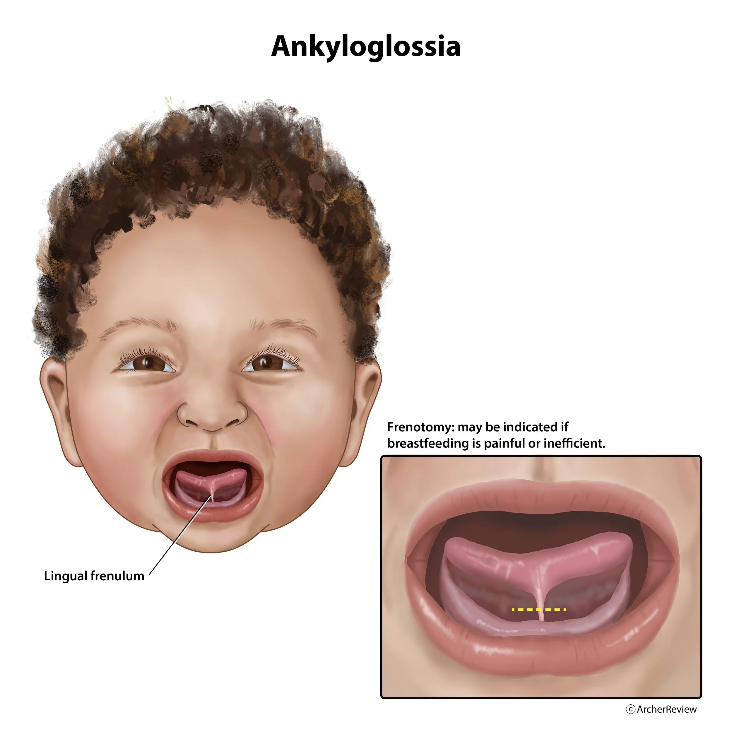 Ankyloglossia