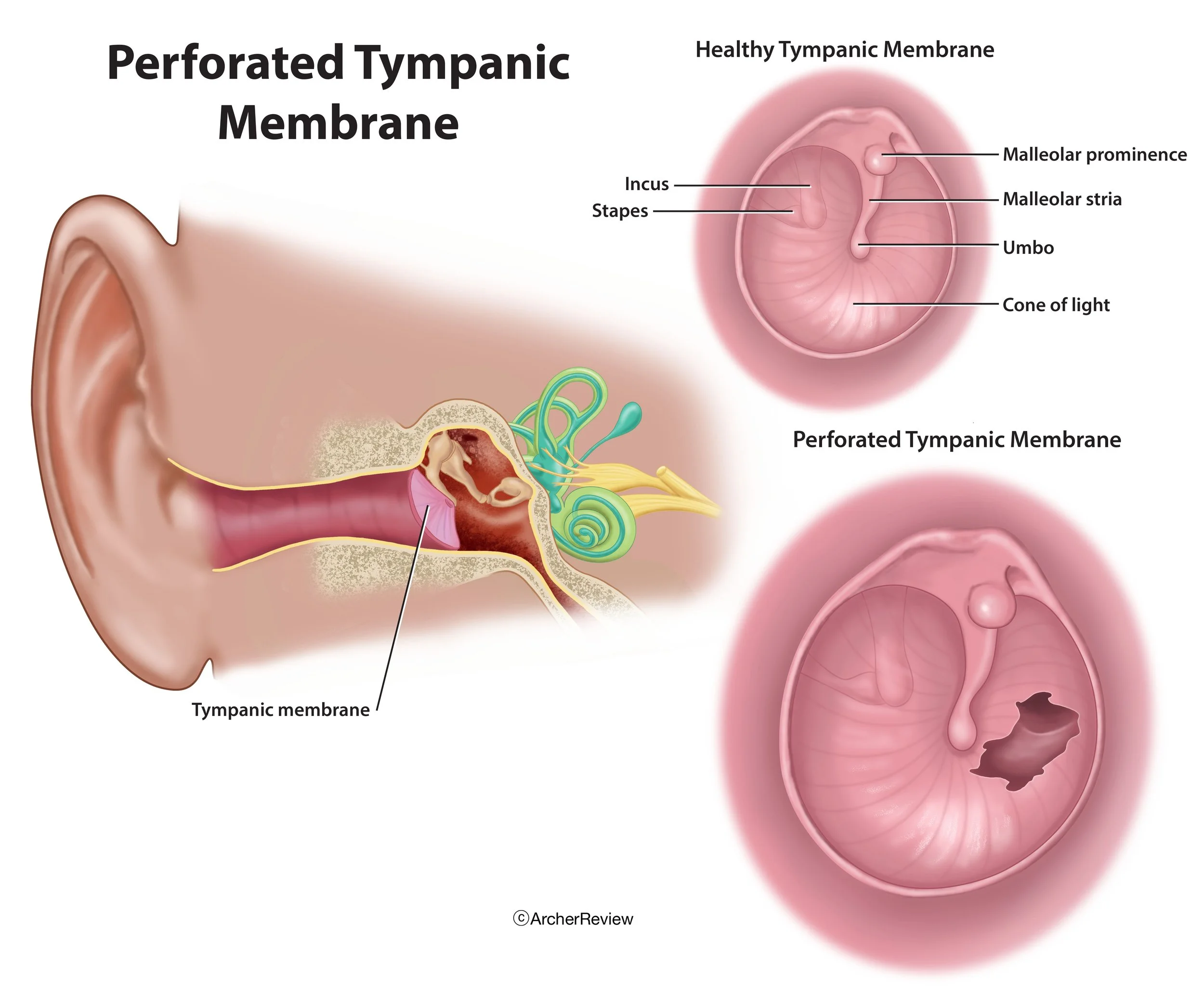 Perforated_Tympanic_Membrane.jpg