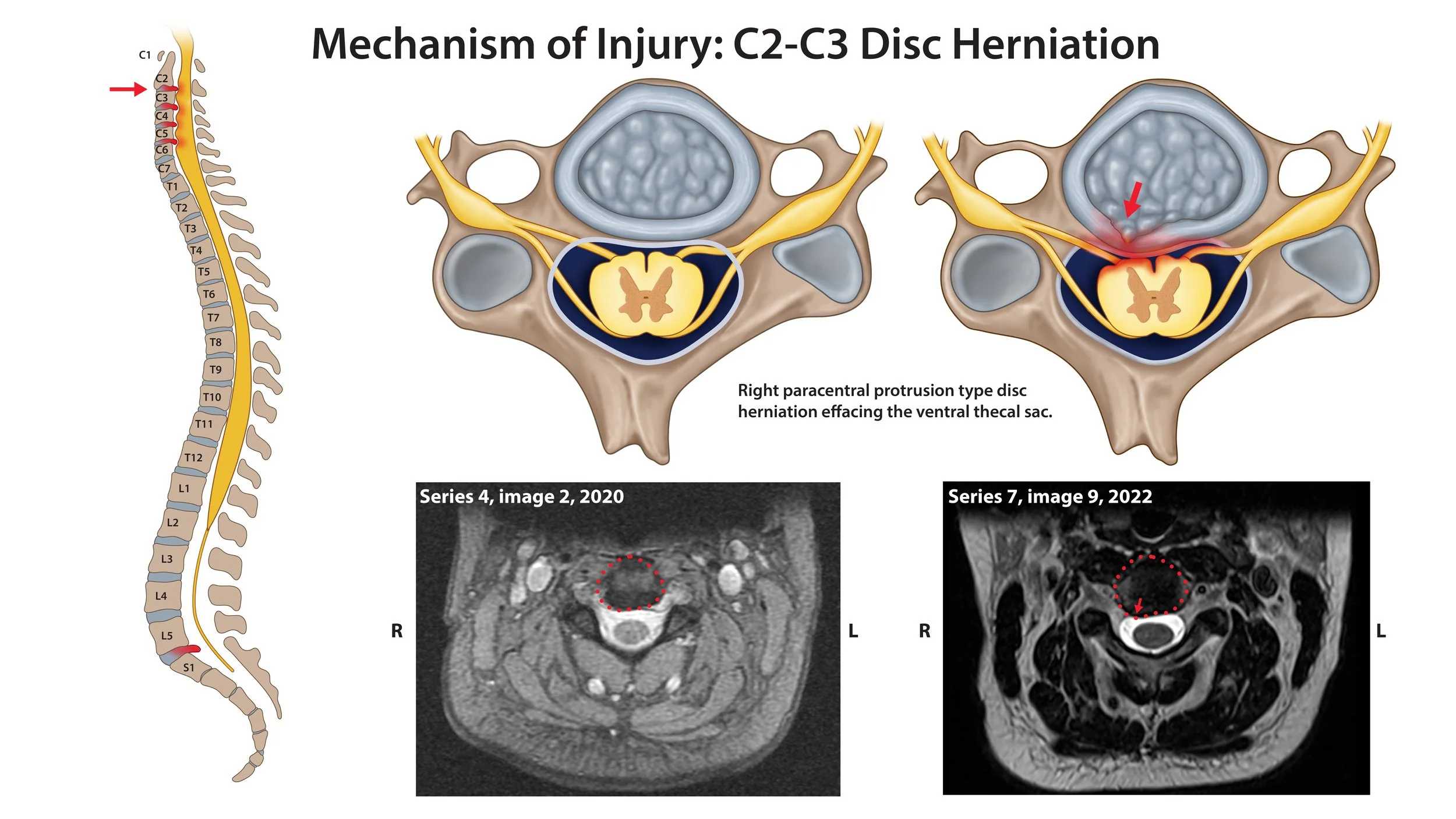 Mechanism of Injury: Disc Herniation