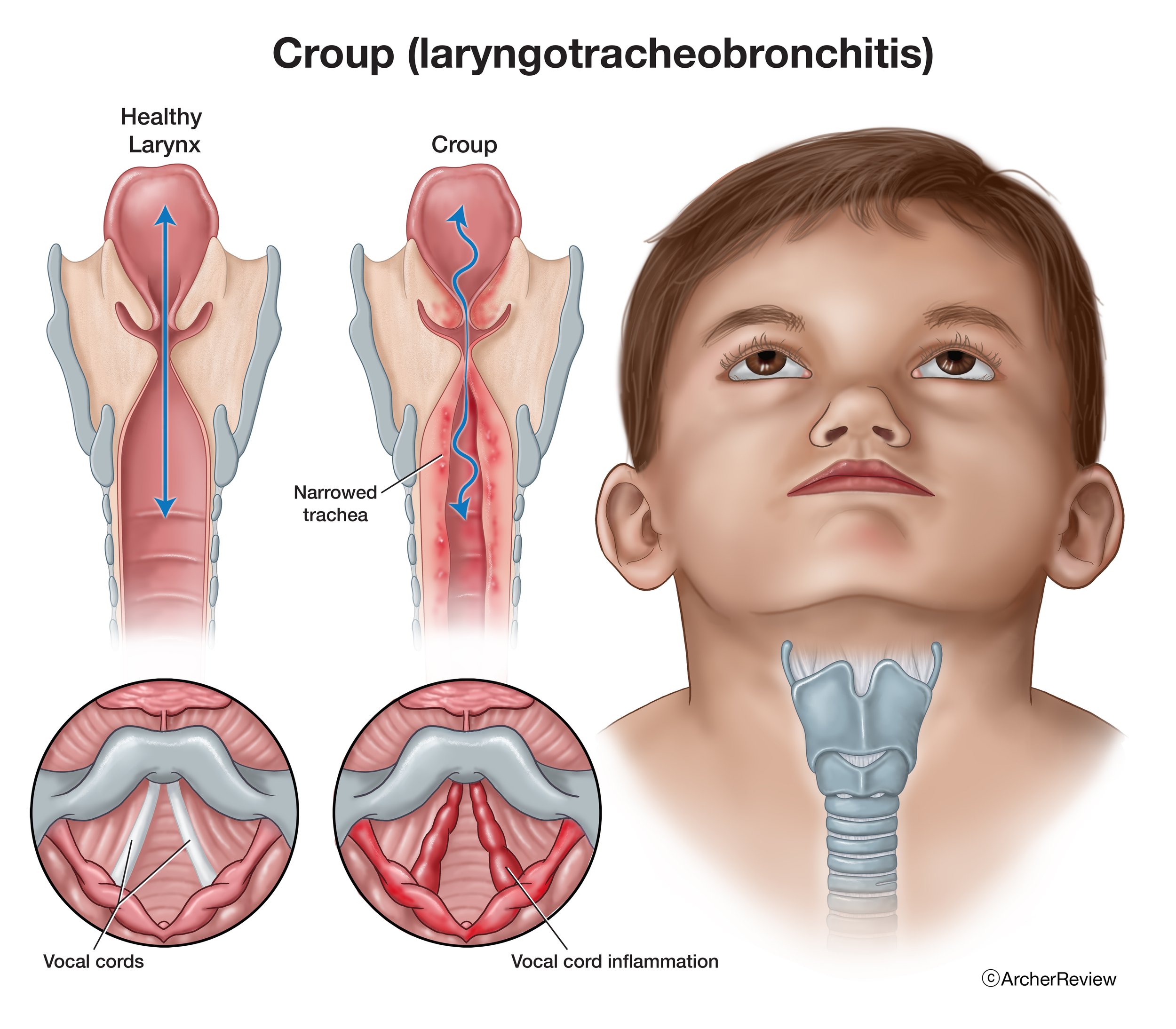 Croup (laryngotracheobronchitis)