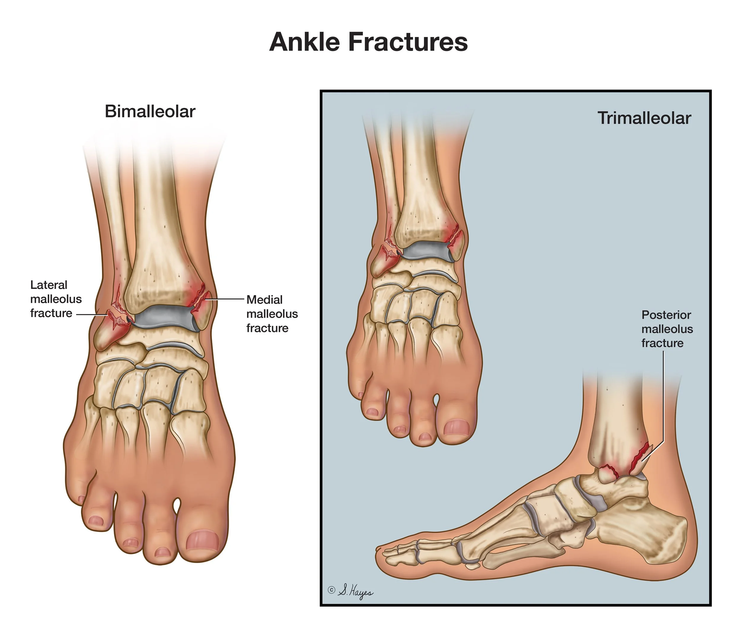 Ankle Fractures