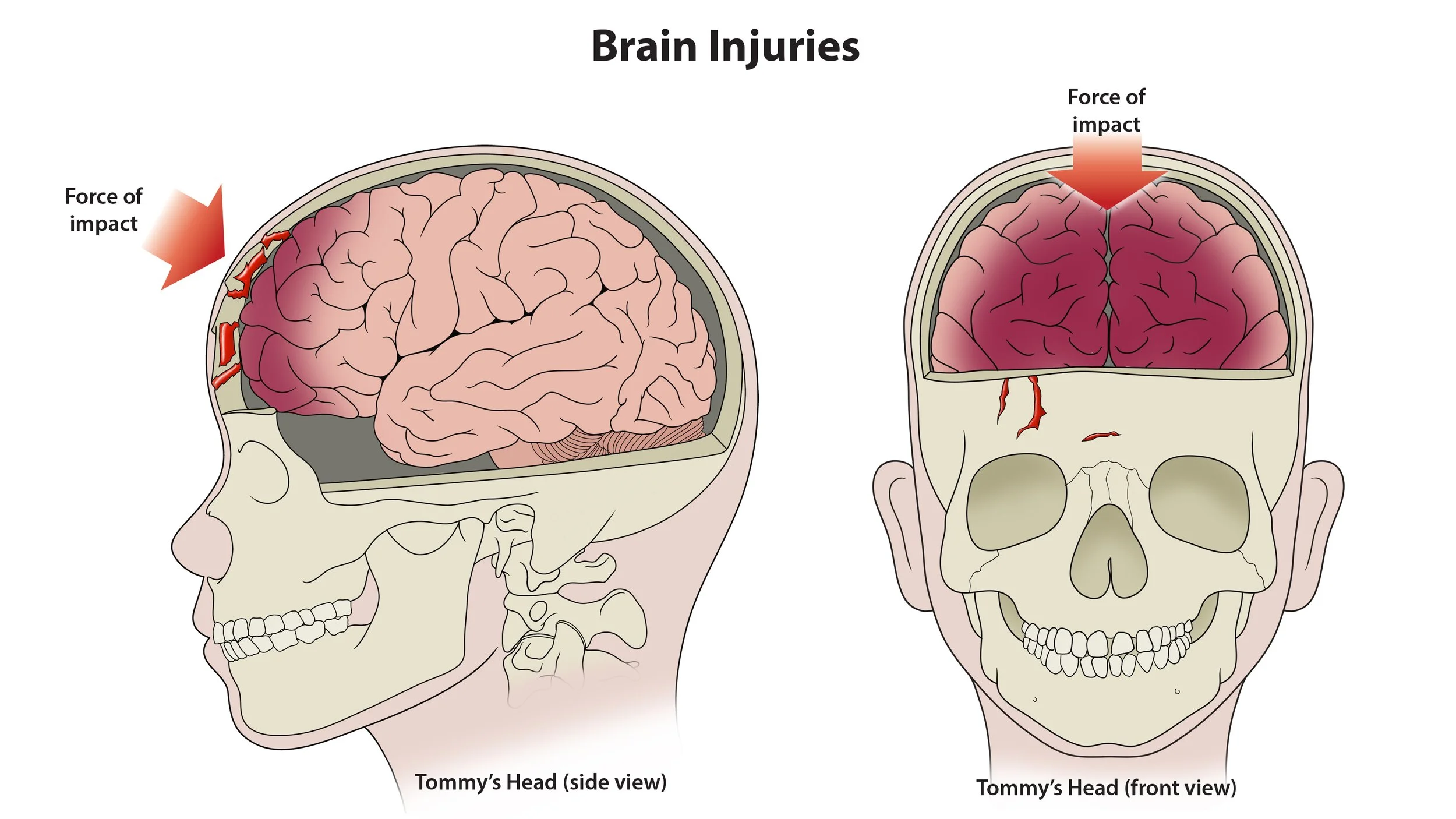 brain_injuries_sb.jpg