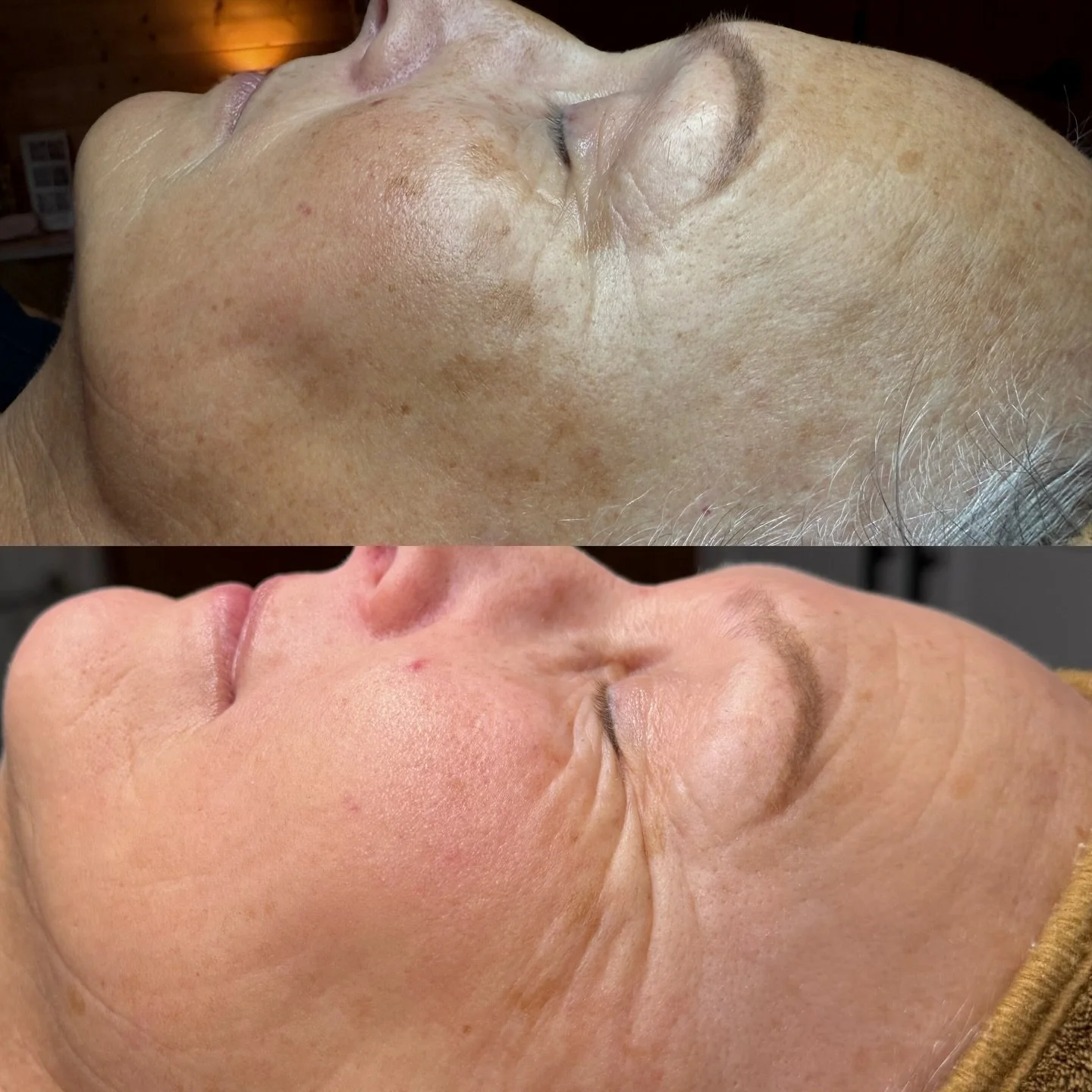 Fighting pigment one peel at a time 🤺
#glymedplus #glymedpluspeels #peelseason #ncesthetician #kingnc