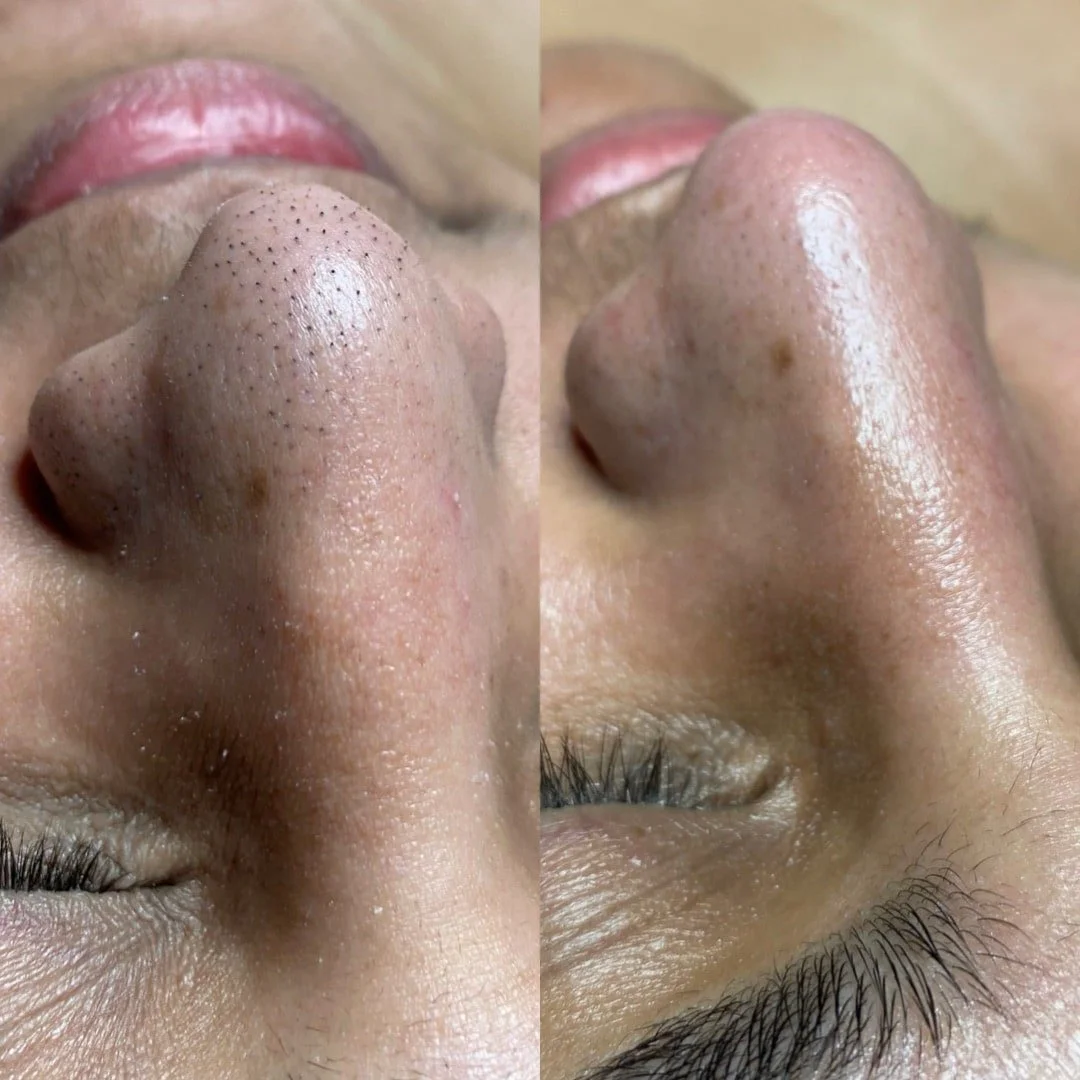 blackhead removal