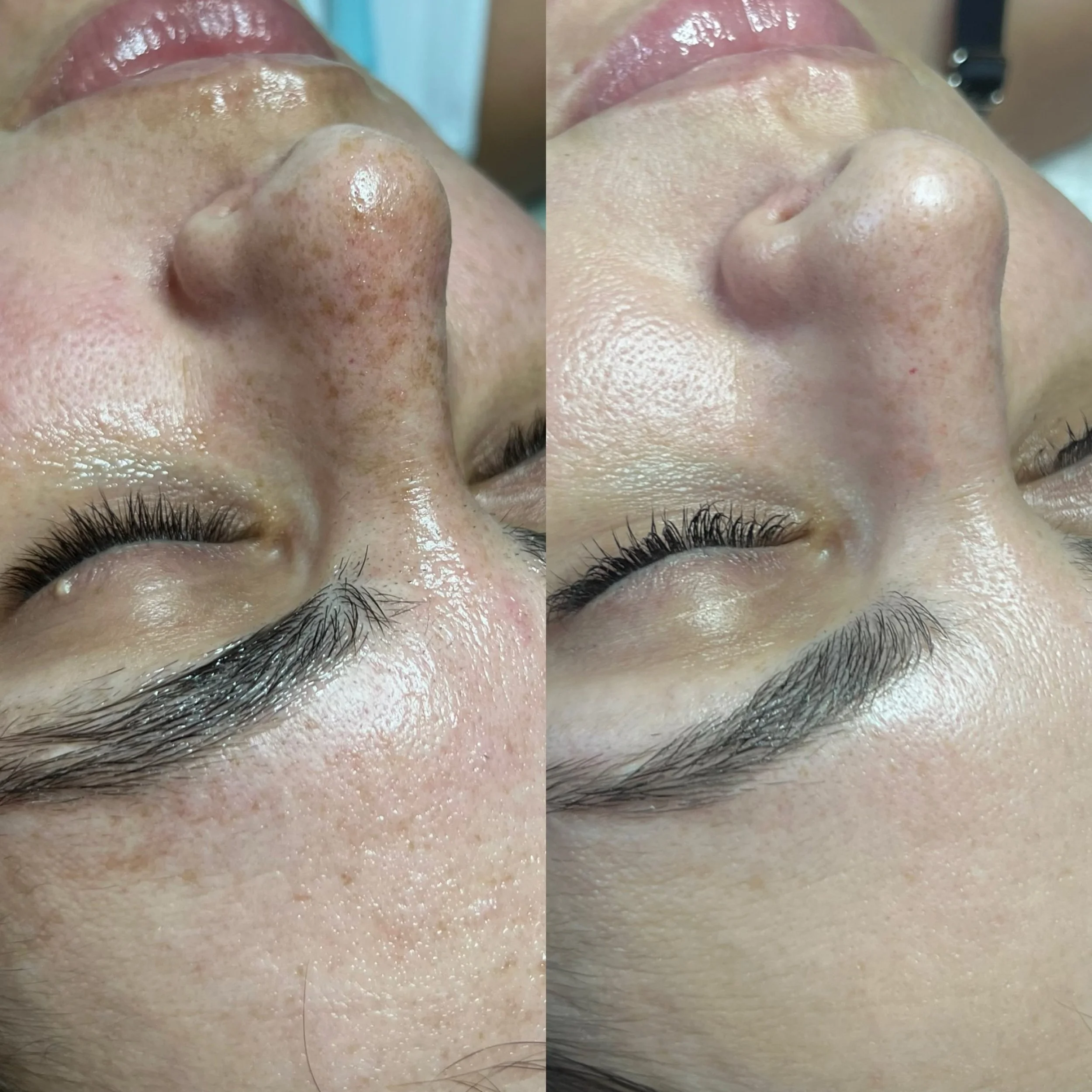 TCA chemical peel