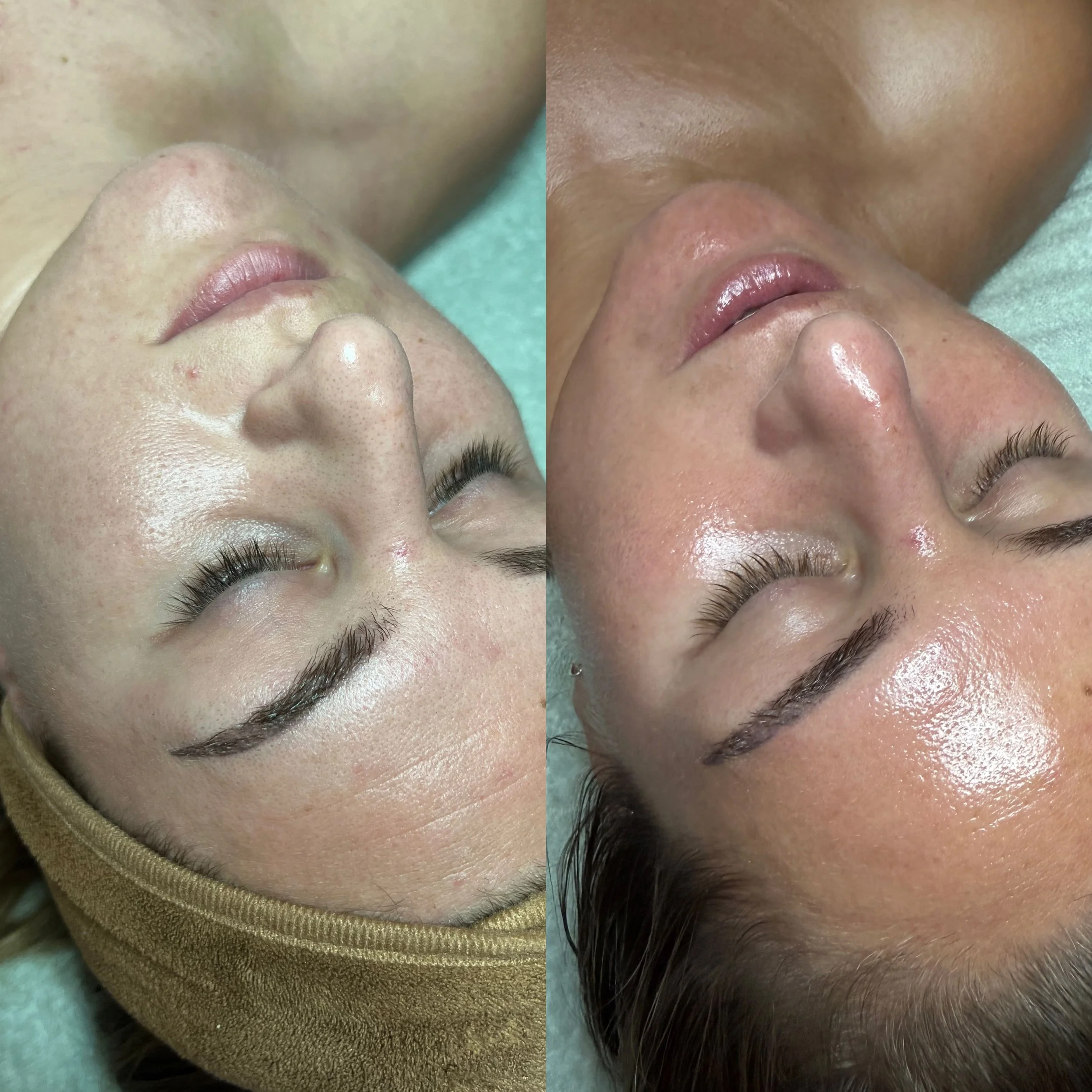 skin tightening microneedling