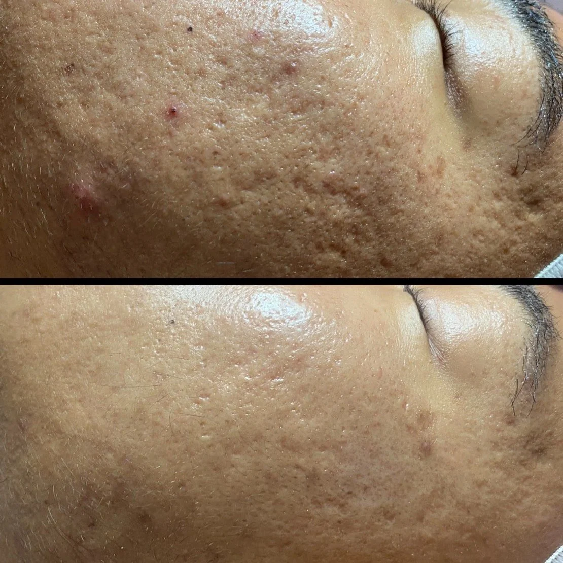 acne scarring microneedling