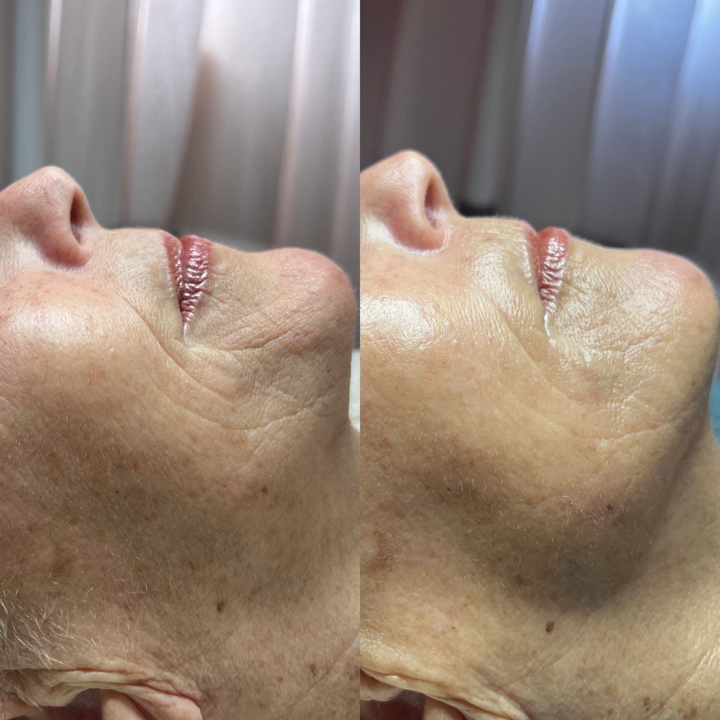 anti-aging glycolic chemical peel
